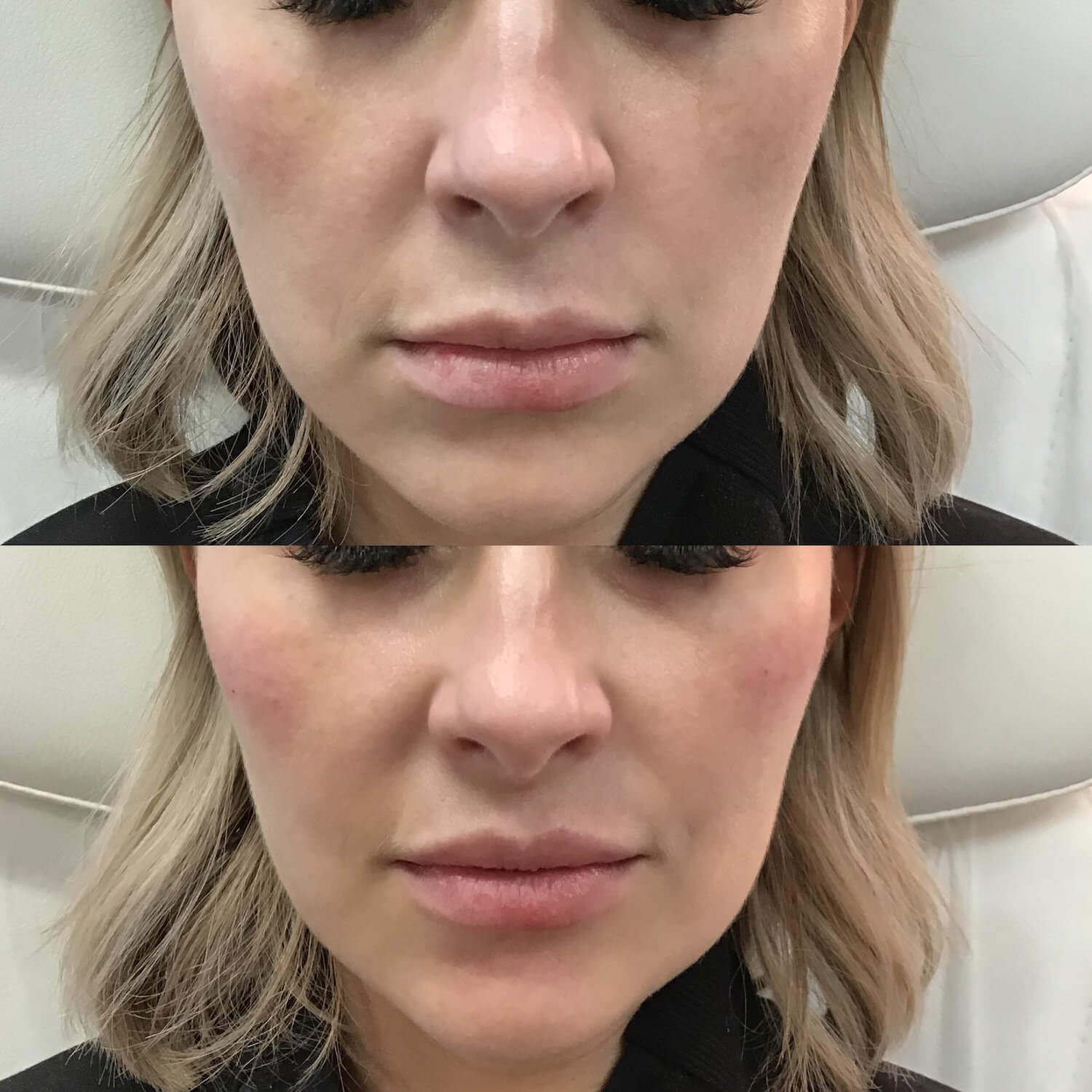 dermal and lip injections bethesda - before and after