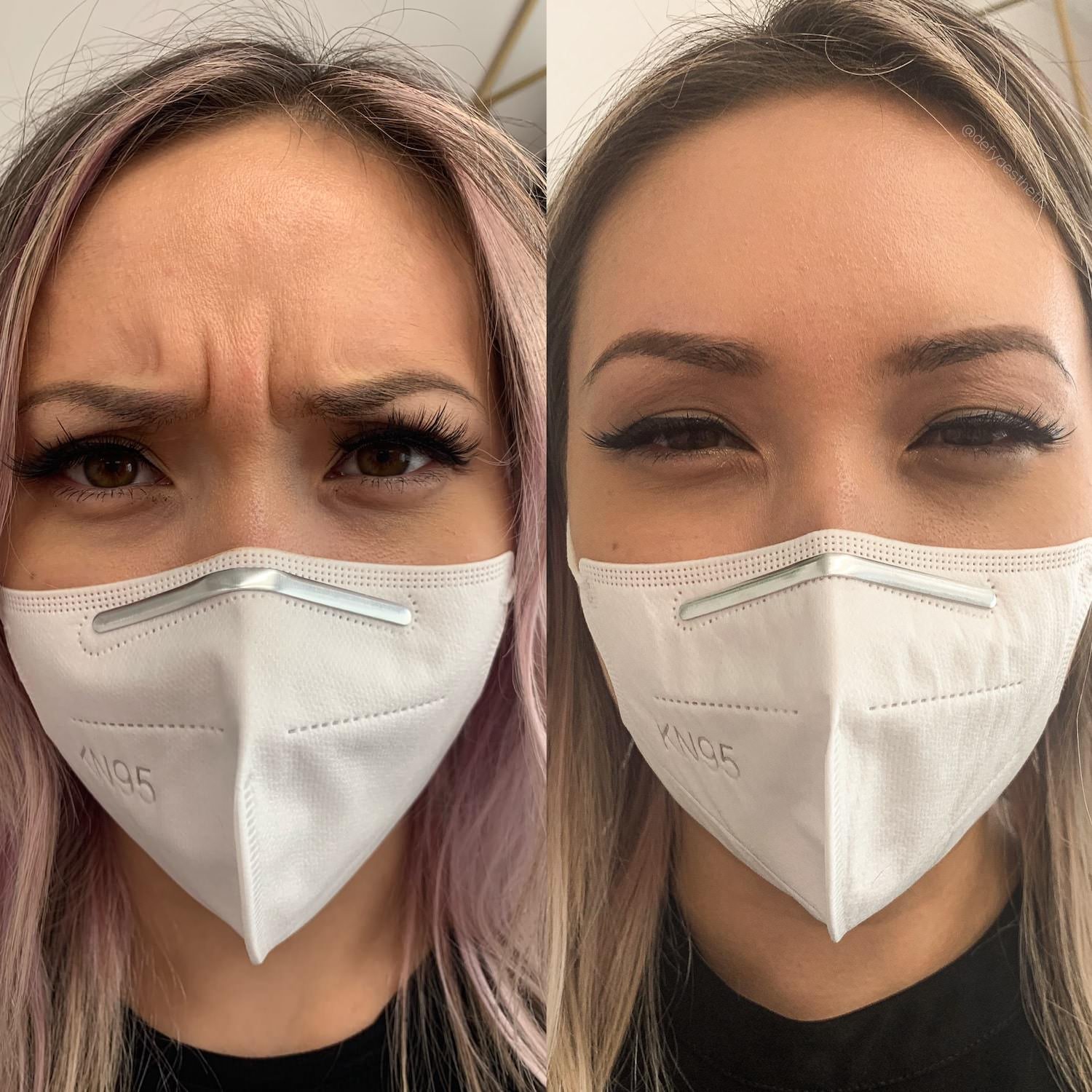 botox bethesda before and after - frown lines