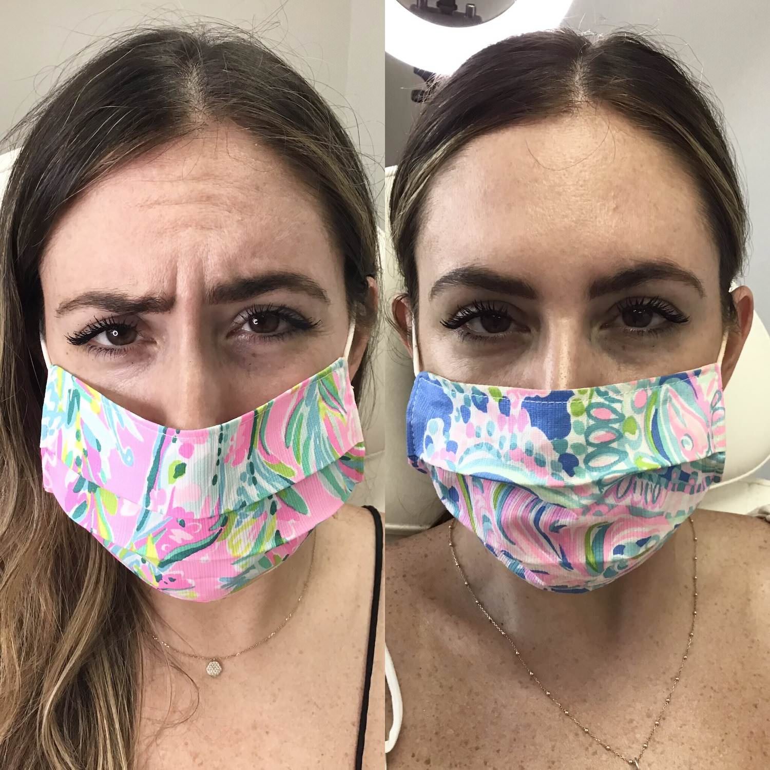 botox bethesda before and after - frown lines