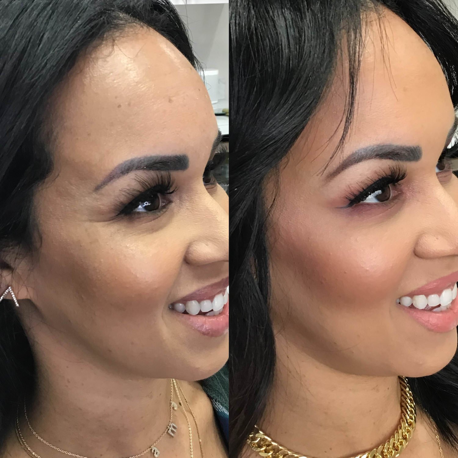 botox bethesda before and after - crows feet