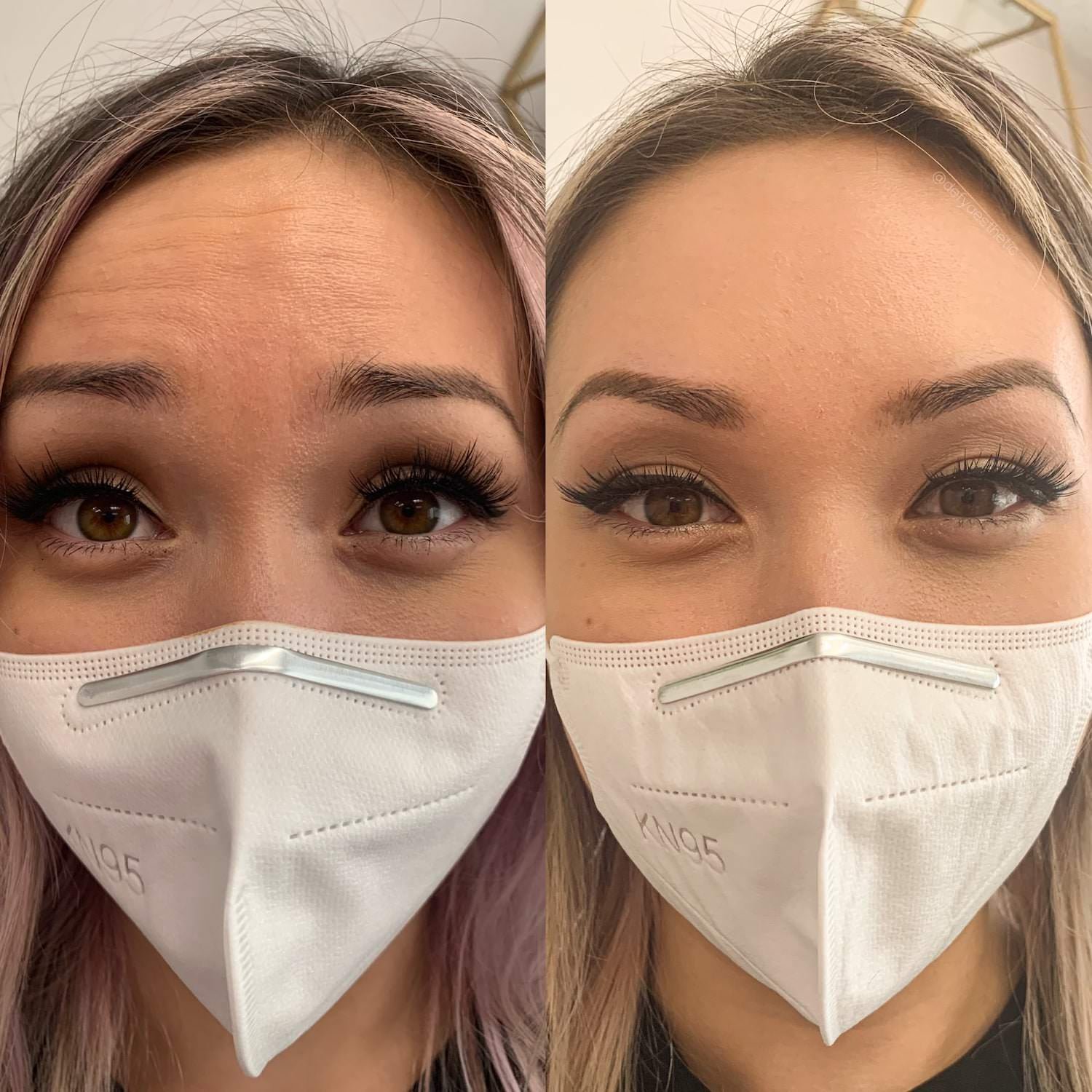 botox bethesda before and after - forehead