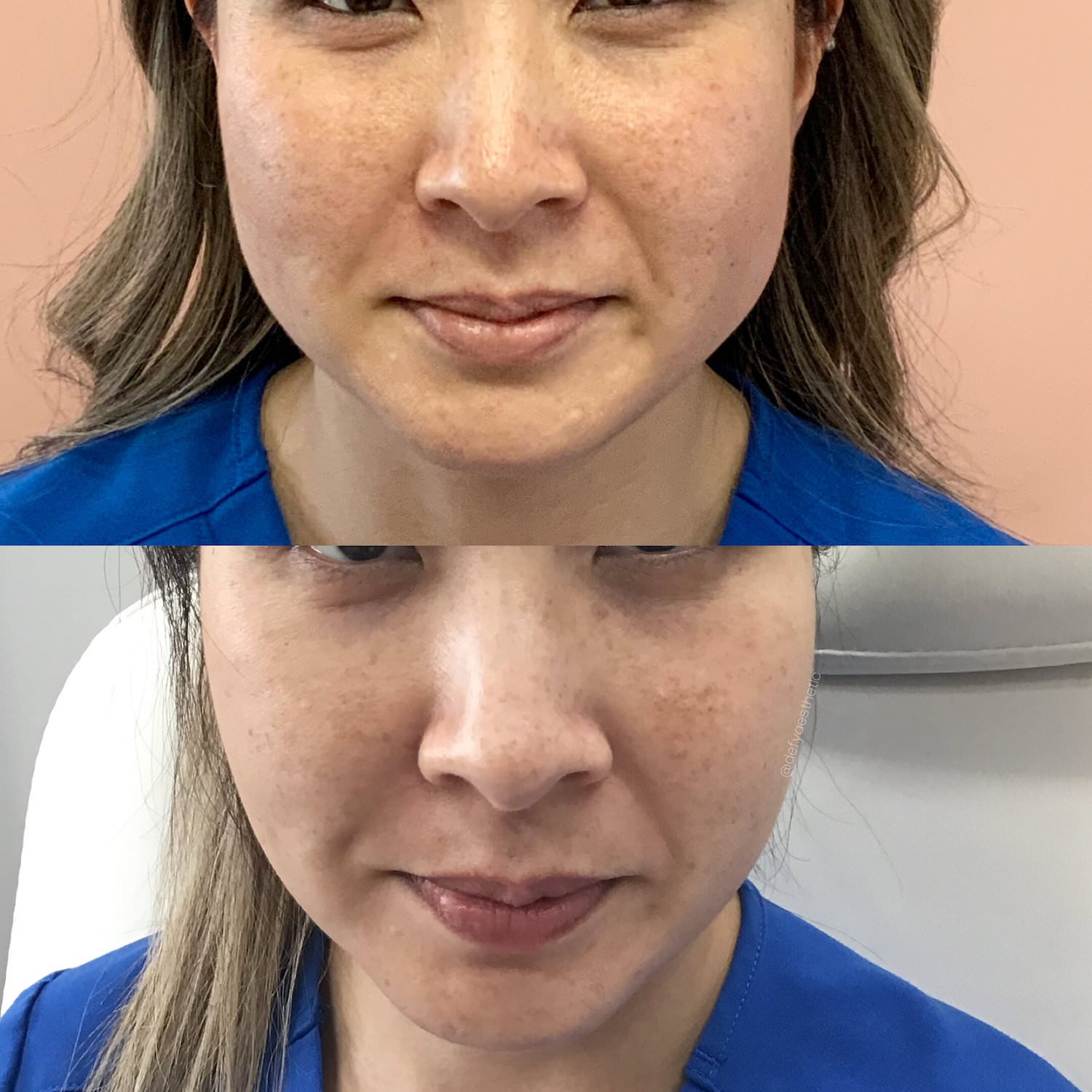 bethesda botox before and after 5.jpg