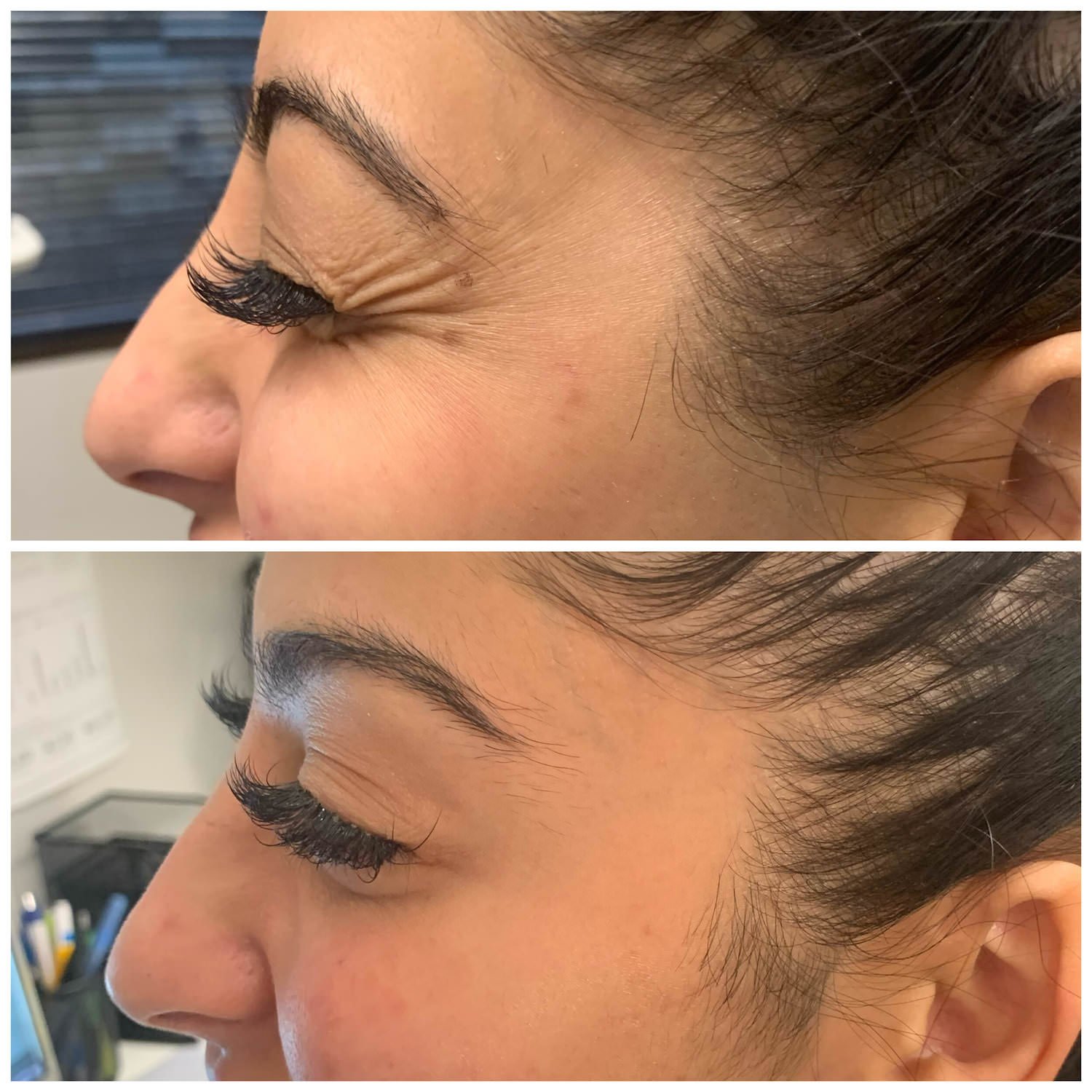 botox bethesda before and after - crows feet