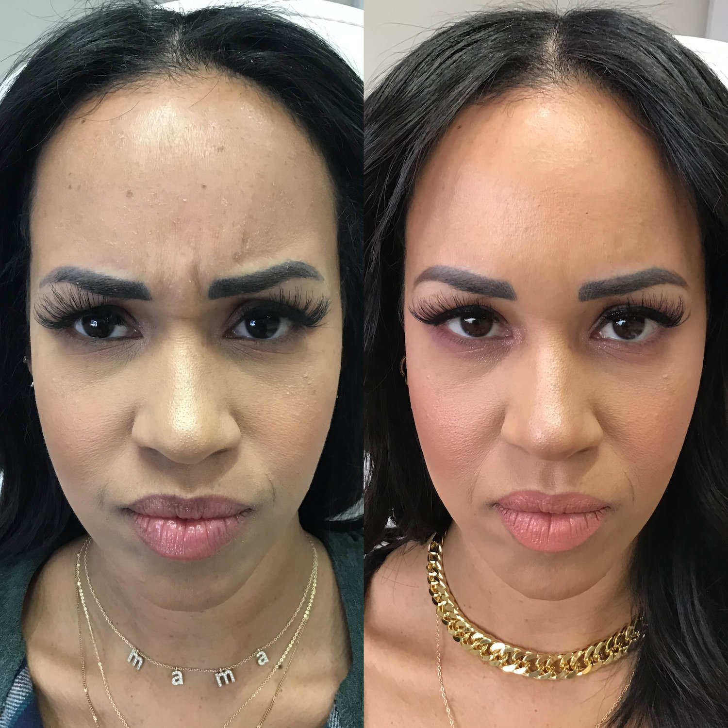 botox bethesda before and after - frown lines