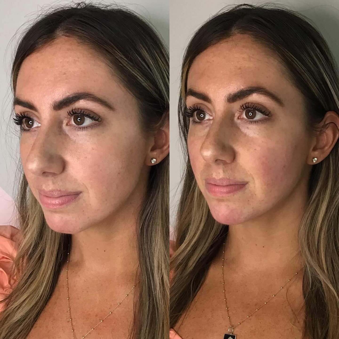 Proof that adding subtle volume to the cheeks and chin can make all the difference. ✨

Just addressing the cheeks would have thrown off her facial proportions, so. we opted for also treating her chin. The result? A seamlessly blended look that&rsquo;