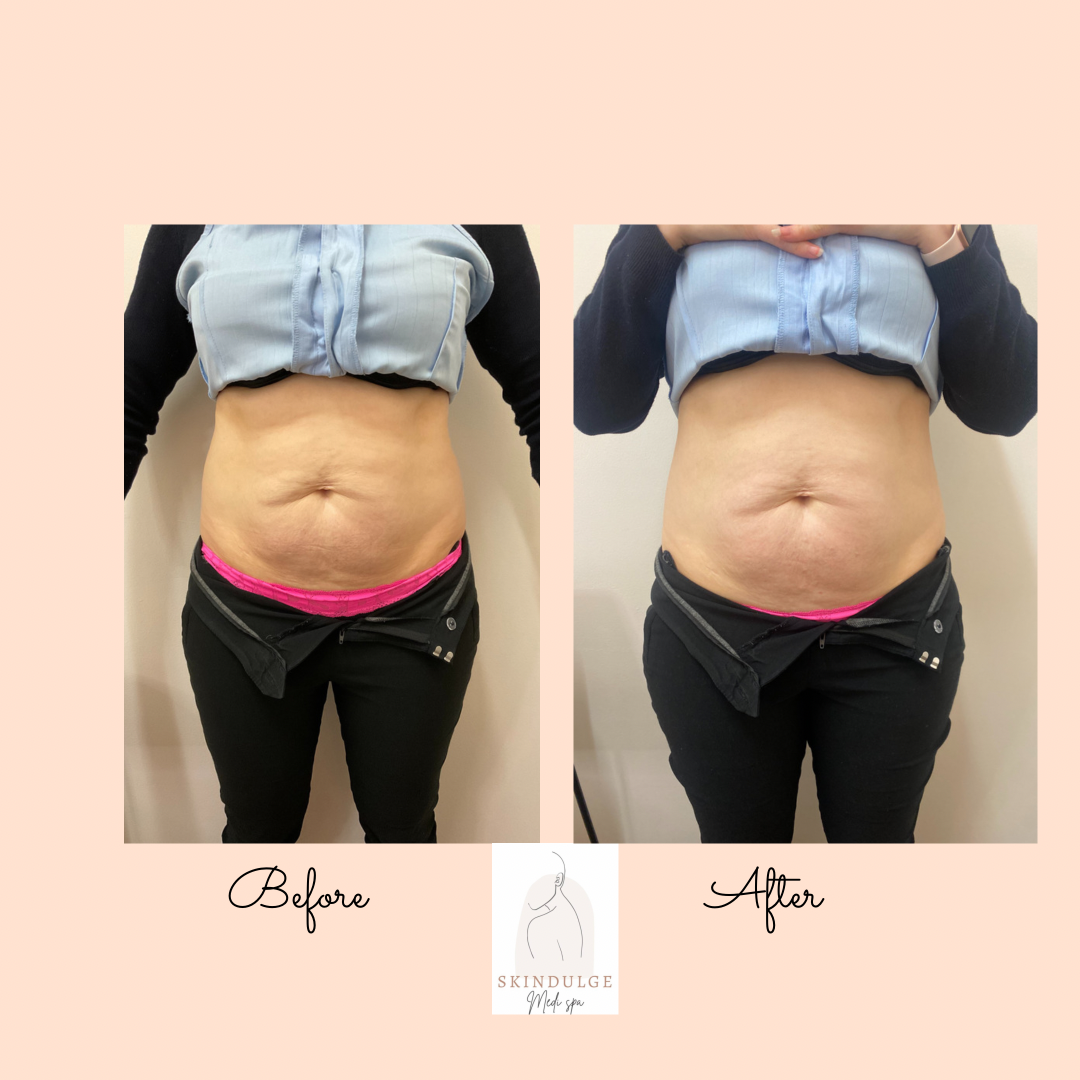 Body Services — Skindulge Medi Spa