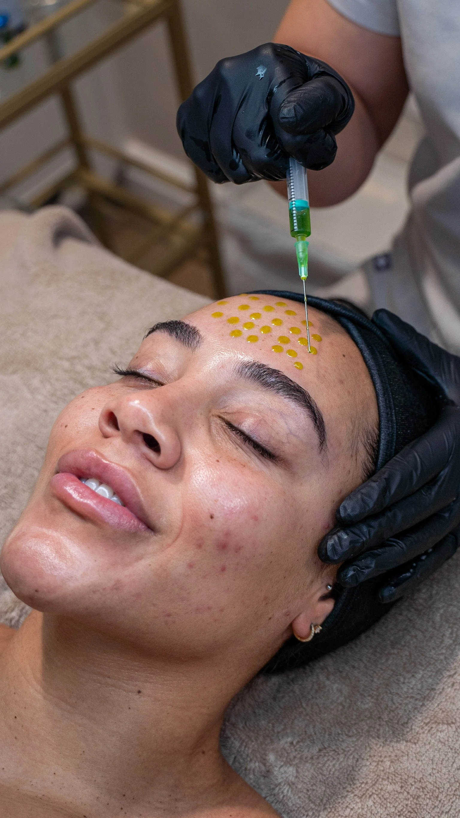 Which Skin Peel Is Right for You?