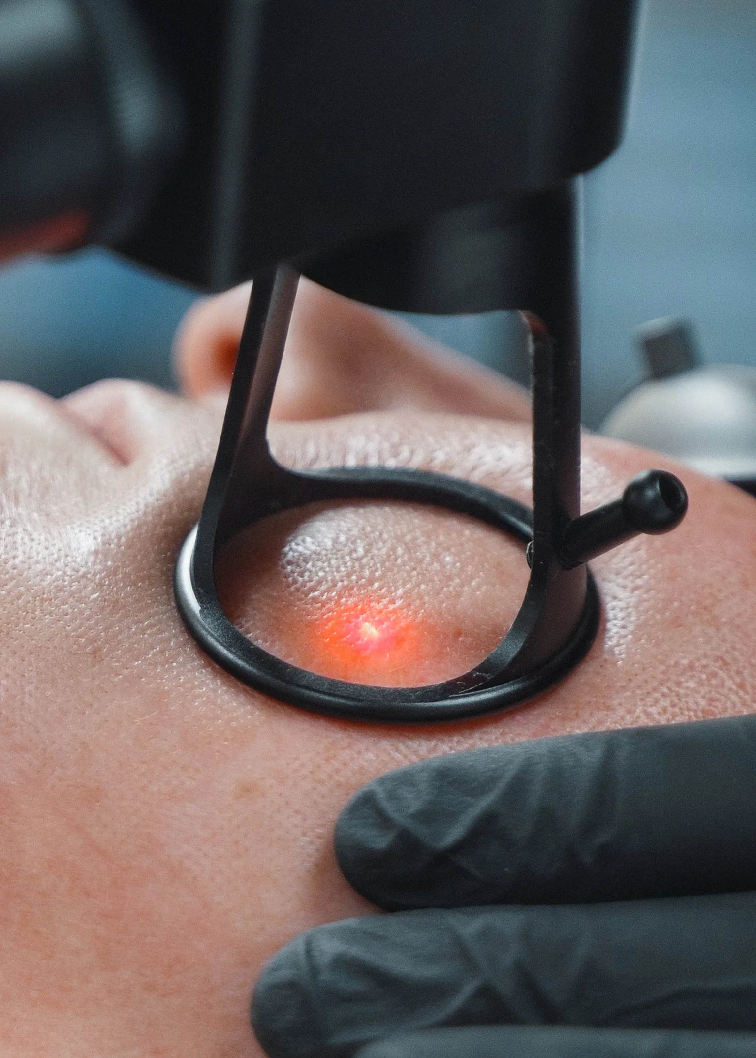 Introducing CO2 Laser: The Next Level Of Skin Rejuvenation