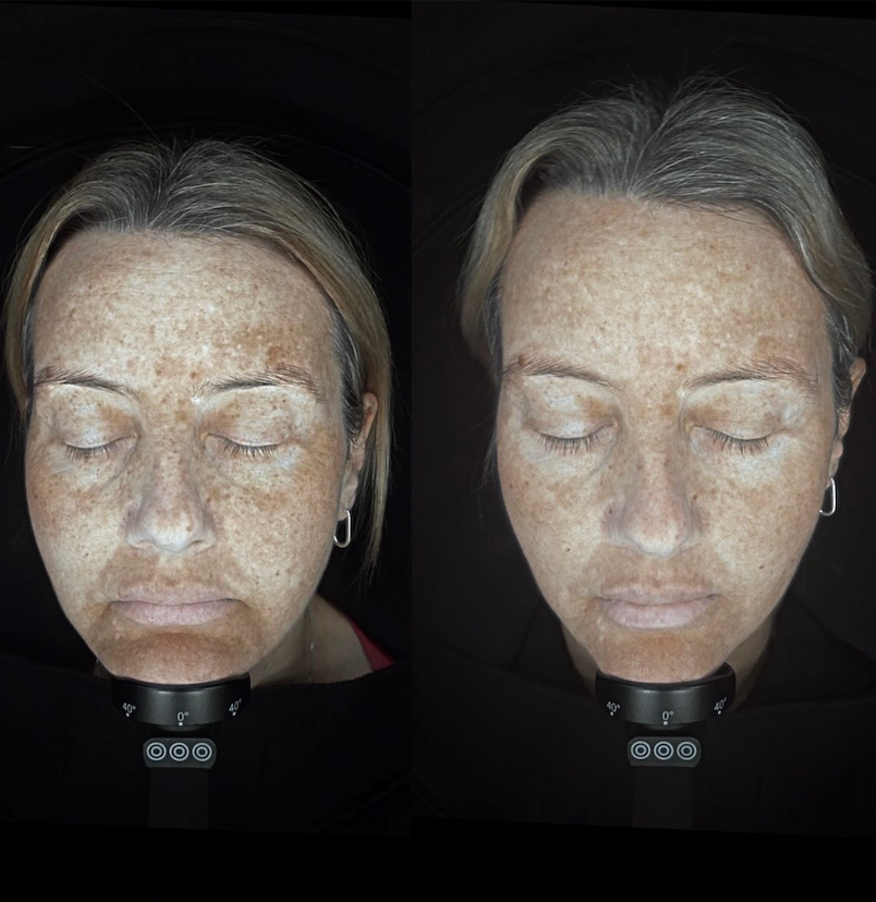 The Summer Left Its Mark: How to Treat Sun Damage and Pigmentation