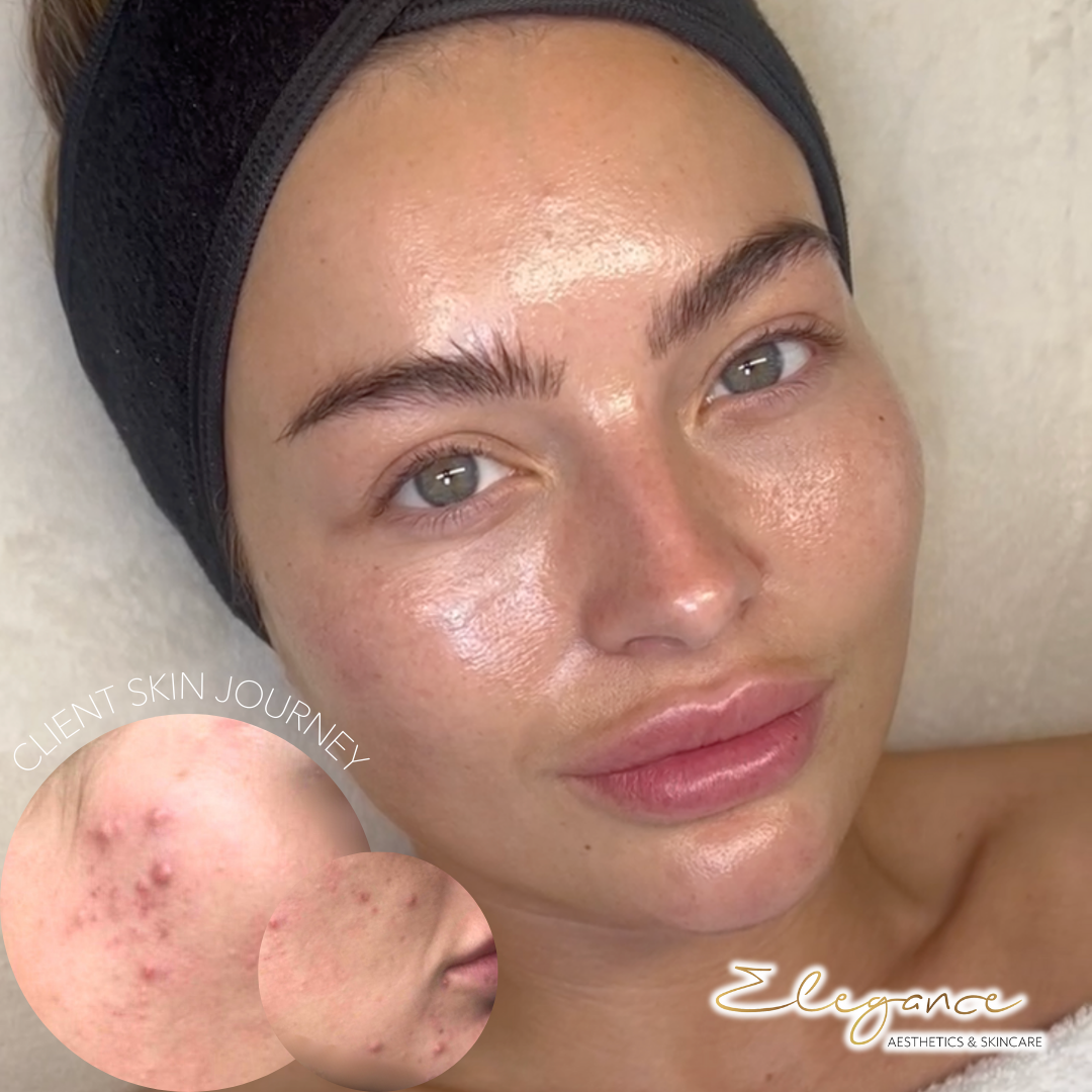 Woman with clear skin wearing a headband, accompanied by an inset showing acne improvement, labeled 'Client Skin Journey' with the text 'Elegance Aesthetics & Skincare'.