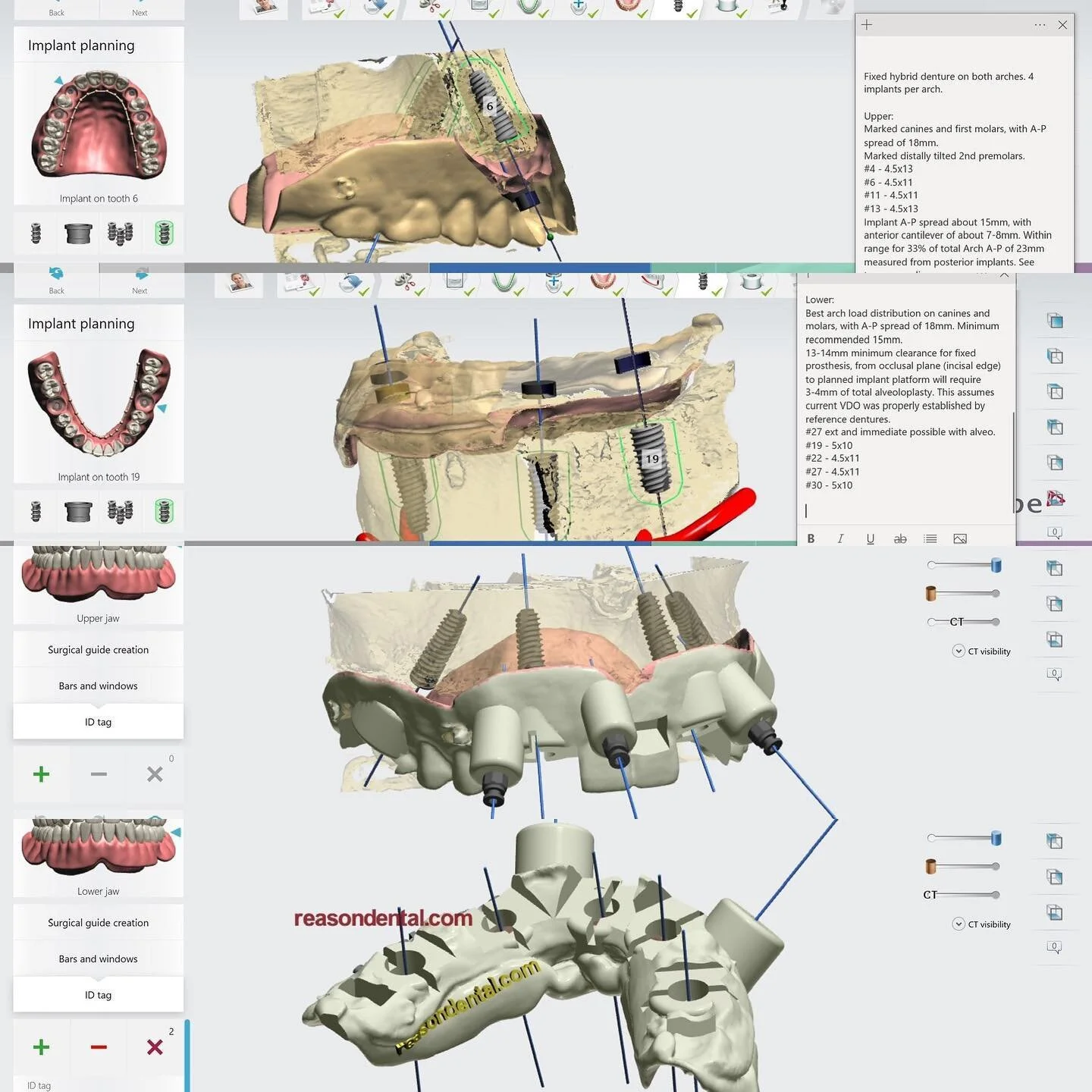 Surgical planning and guide design for AOX. Planned immediate loading with pre-printed dentures. #implantdentistry