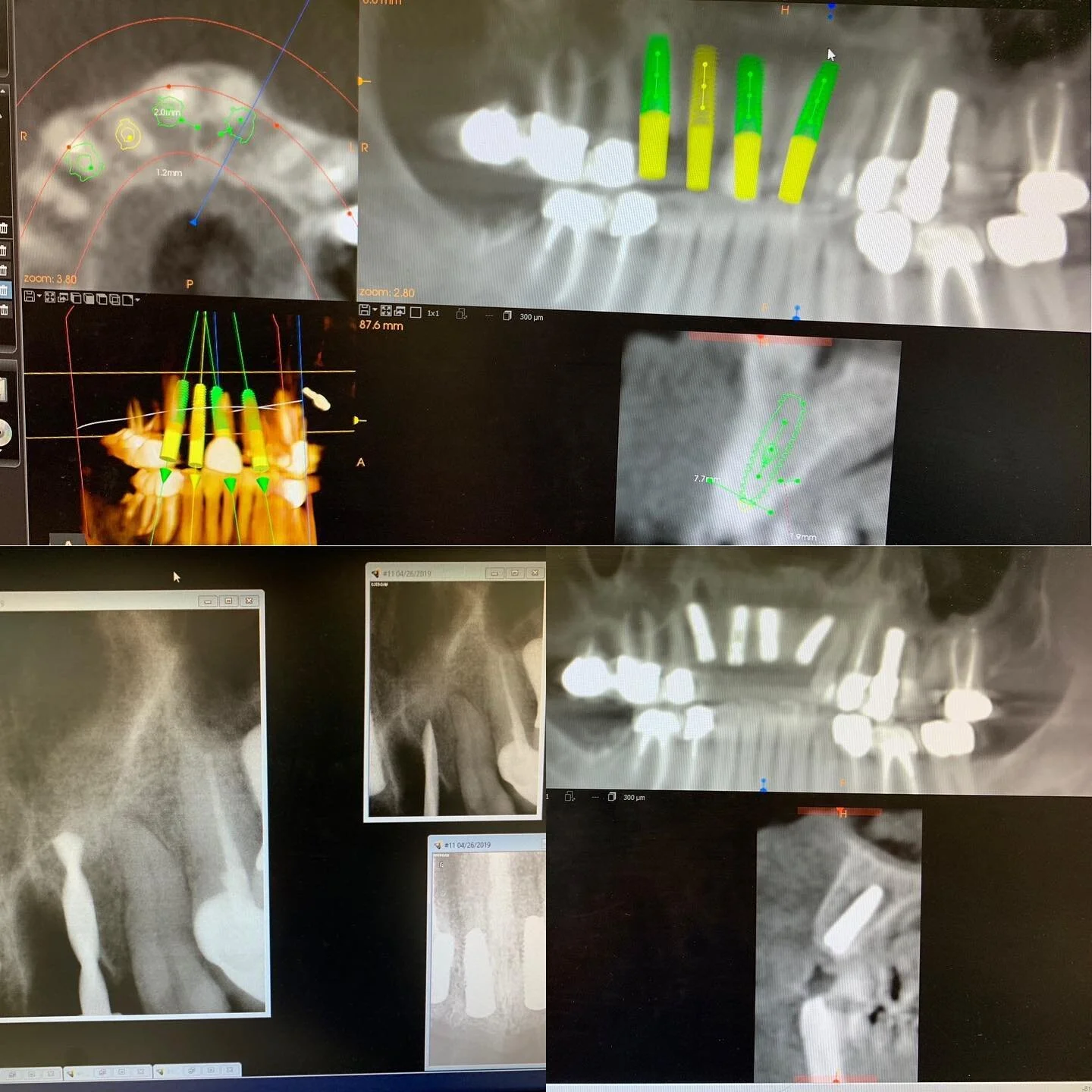 Immediate ext, placement and GBR. Open membrane technique, first stage. Male patient