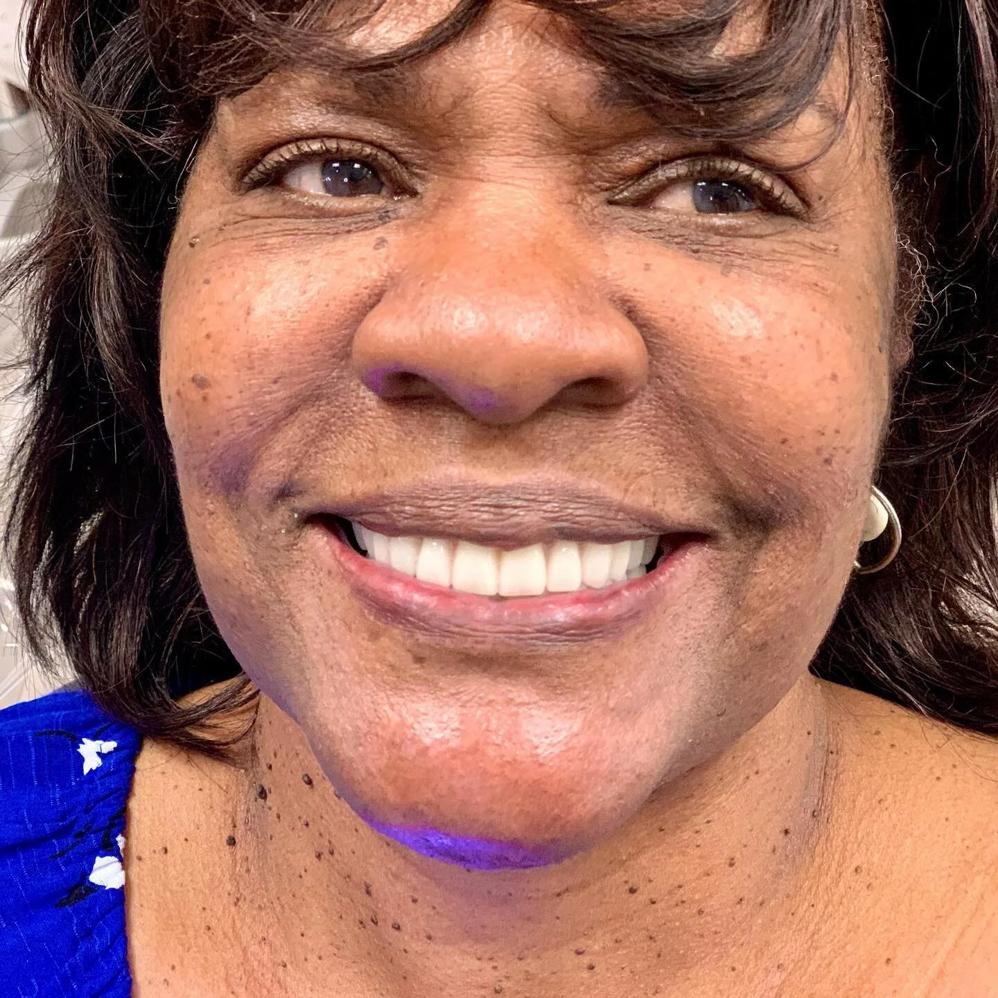 AO4 double arch restoration. 3D-milled PMMA temps and final acrylic over titanium bars. Dual-arch perfect positioning, alignment, VDO, and phonetics.