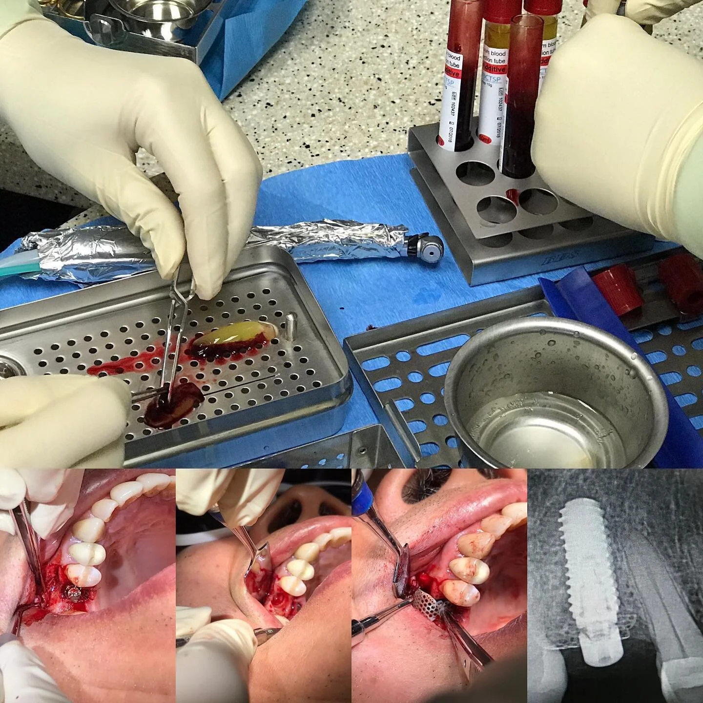 Implant removal with trephination and immediate implant placement, and buccal plate regeneration with Ti-mesh and L-PRF. One stage surgery.