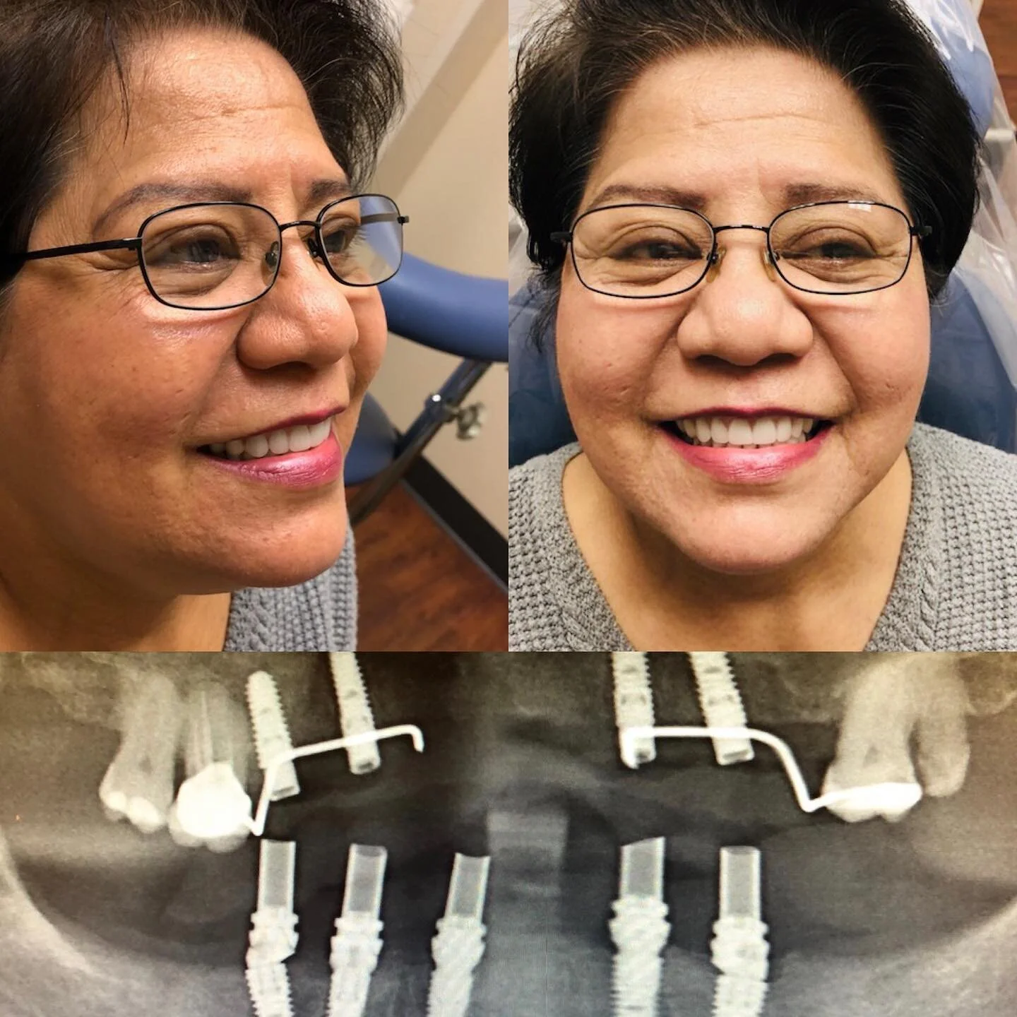 Implant supported RPD and full-arch AOX immediate load and conversion with tilted implants. Also known as smile-in-a-day protocol. Pictures from day of surgery.
