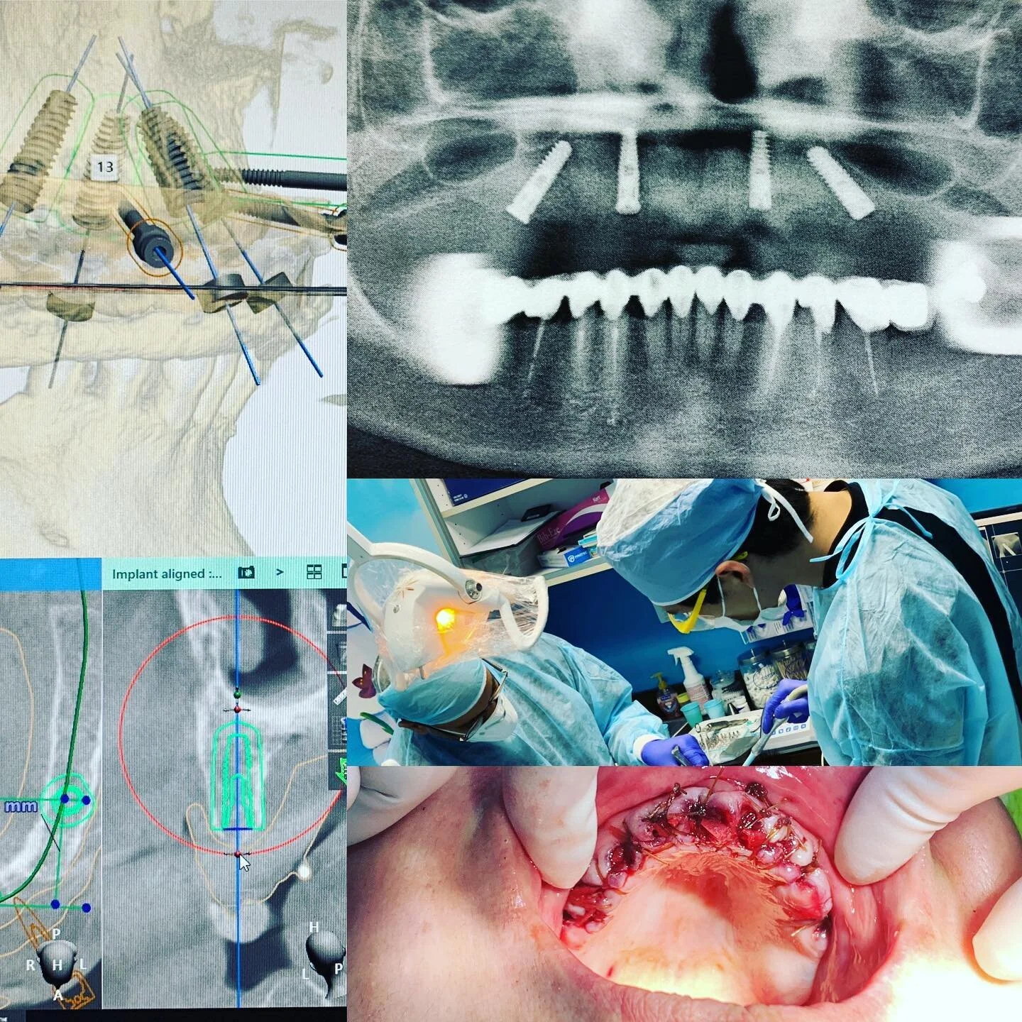 AO4, full arch hybrid with guided tilted implants. Full arch graft, GTR with dermal matrix for healthy KT regeneration.