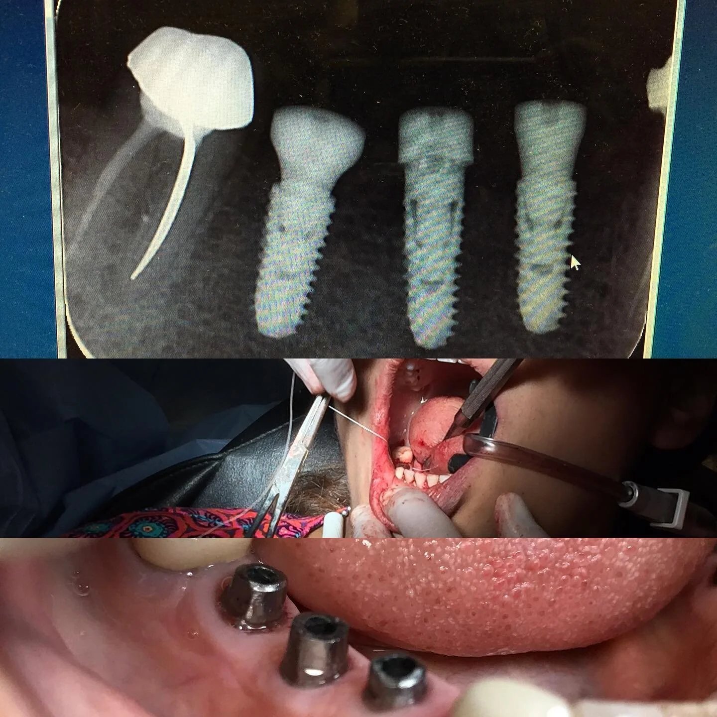 Ridge split with immediate placement, 3mm expansion, buccal plate fracture and bone reconstruction with Ti-mesh and STG dermal matrix. Original ridge was 3-4mm thin, full size implants 4mm were placed. One stage surgery.