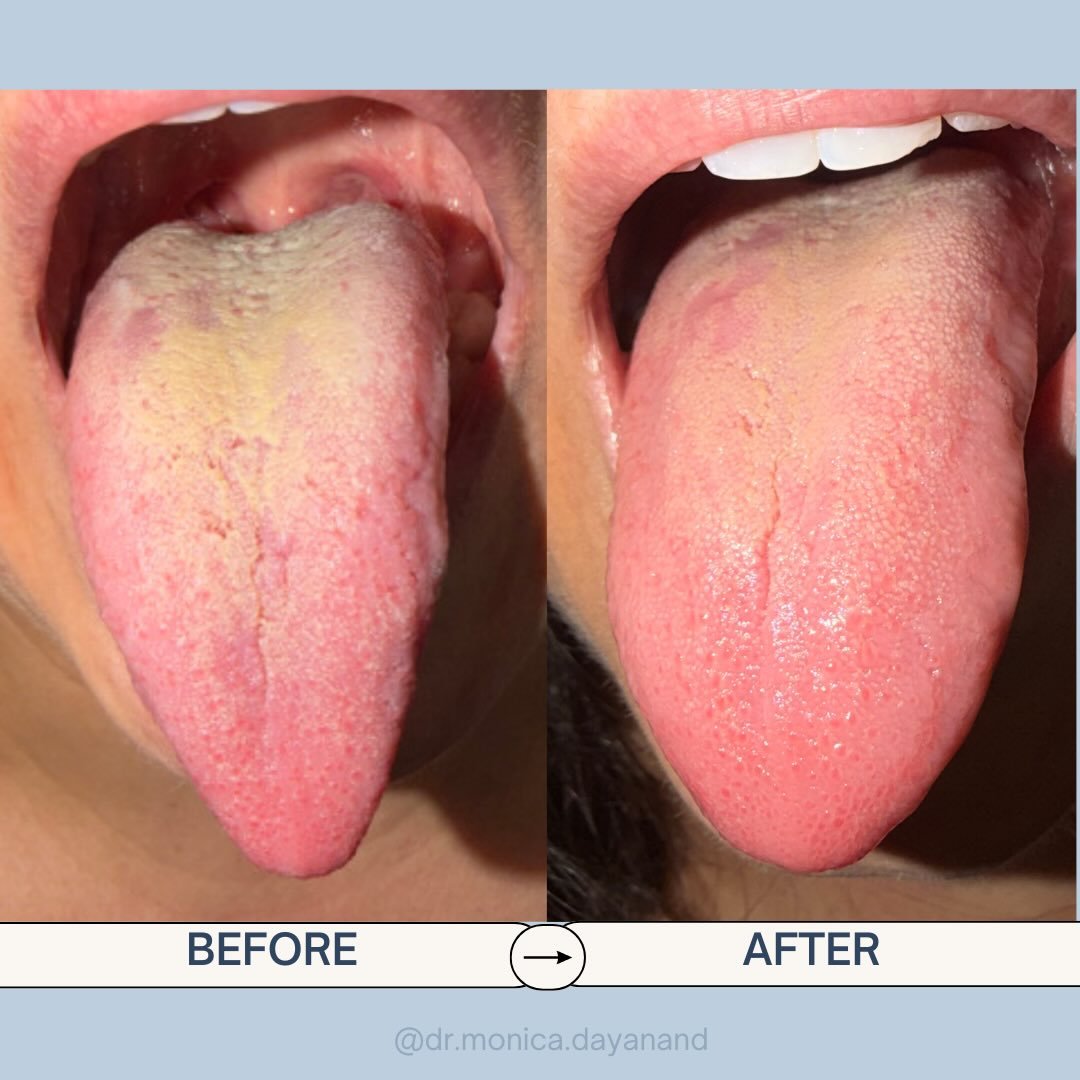 WOW!! Can you spot the difference?? 😮👀 

These photos were taken just over ONE MONTH apart!

My patient, &ldquo;Jane,&rdquo; is in her second month of IVF preparation and has been incredibly consistent with her care &mdash; following her customized