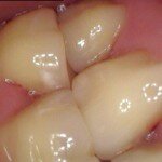 teeth-worn-flat-due-to-grinding-idaho-falls-150x150.jpeg