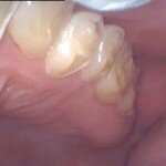 teeth-chipped-due-to-grinding-photo-idaho-falls-150x150.jpeg