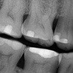 teeth-worn-flat-with-grinding-idaho-falls-150x150.jpeg