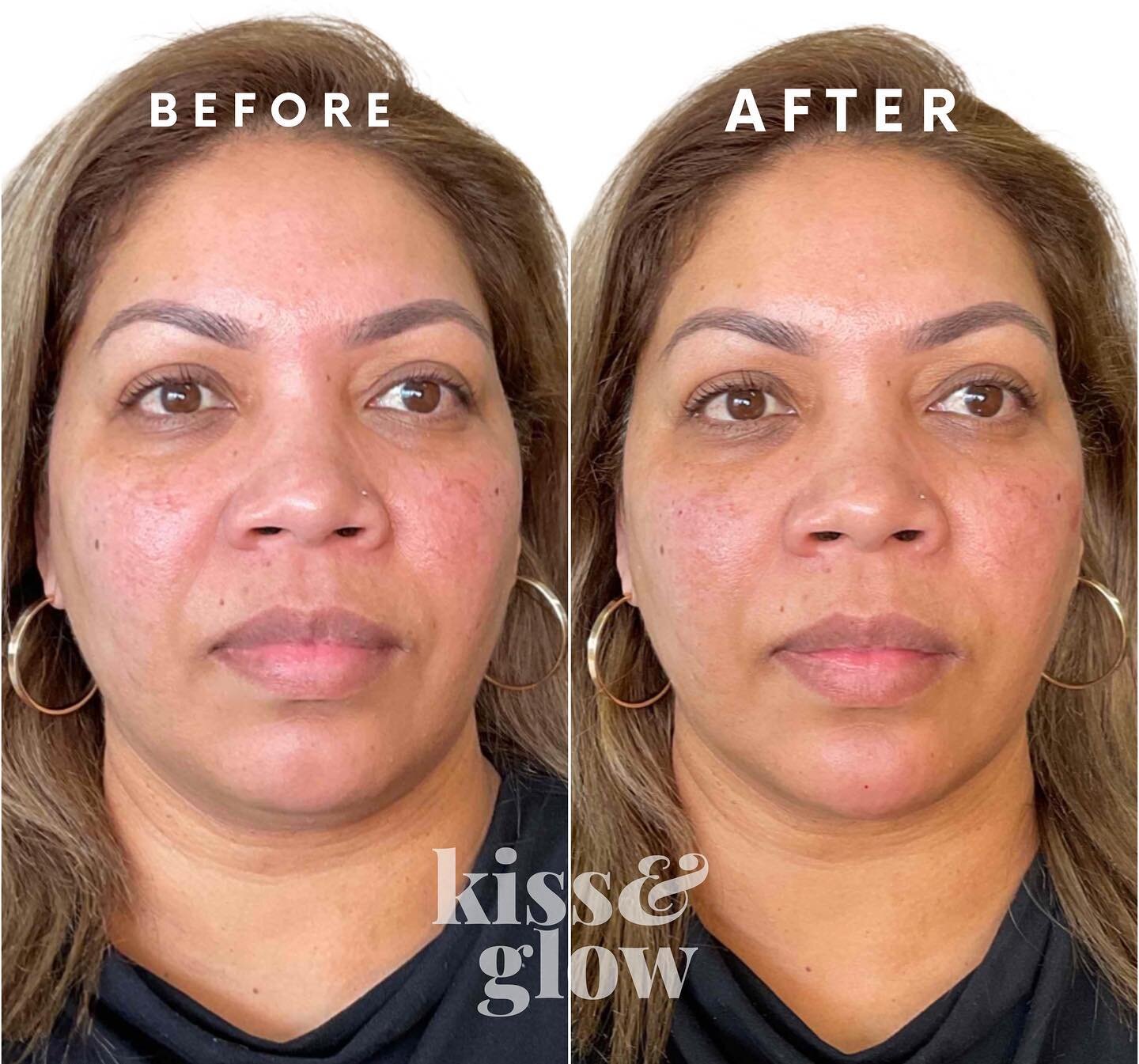 This lovely client has had both a chin and cheek augmentation 

Chin filler can contribute to a balanced and harmonious facial structure, helping you achieve a heart-shaped face, while creating the illusion of slimming down the lower face

Likewise c