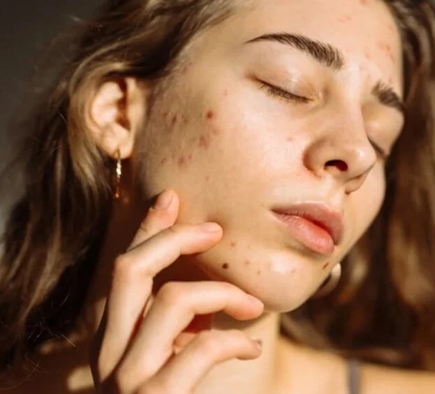 Close-up of a young woman with clear skin and some acne, with her eyes closed and touching her cheek gently.