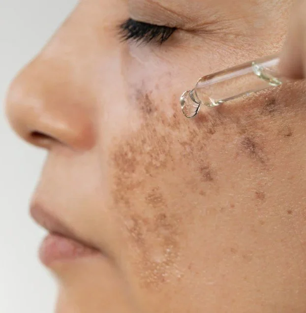 Close-up of a woman's face with a dropper applying skincare serum to her cheek.