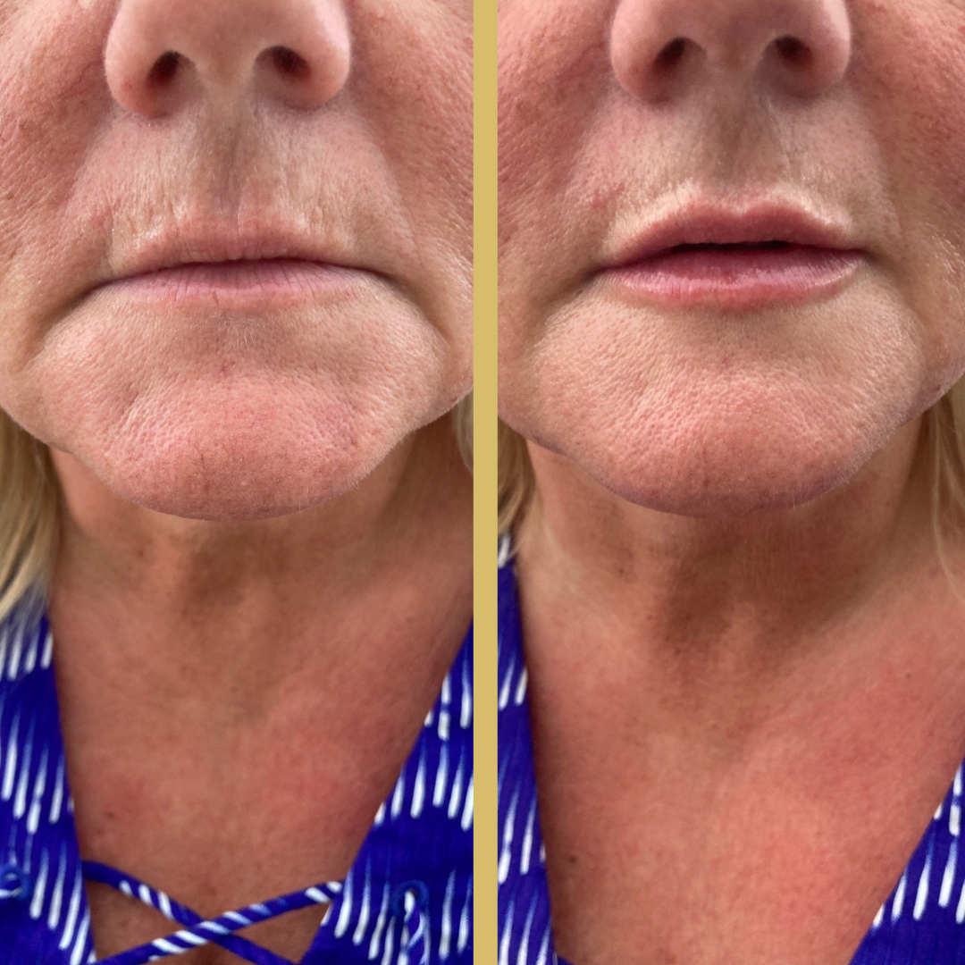 before and after lips.PNG