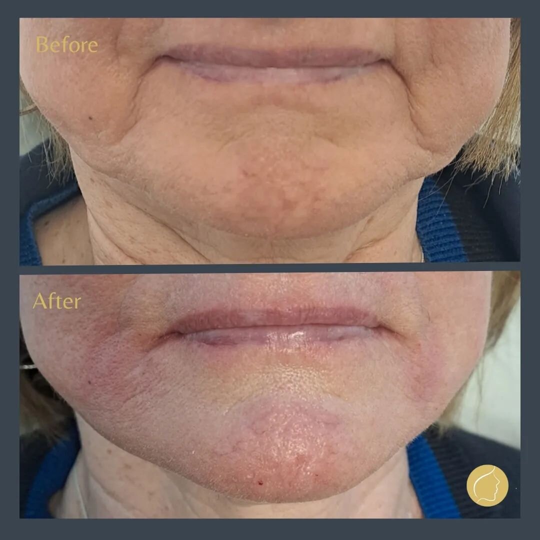 Some more fantastic results!

This client has had 1ml of Juvederm Voluma filler to her marionette lines - the lines between the mouth and chin.

As we age, we can start to develop marionette lines because of a natural reduction in collagen production