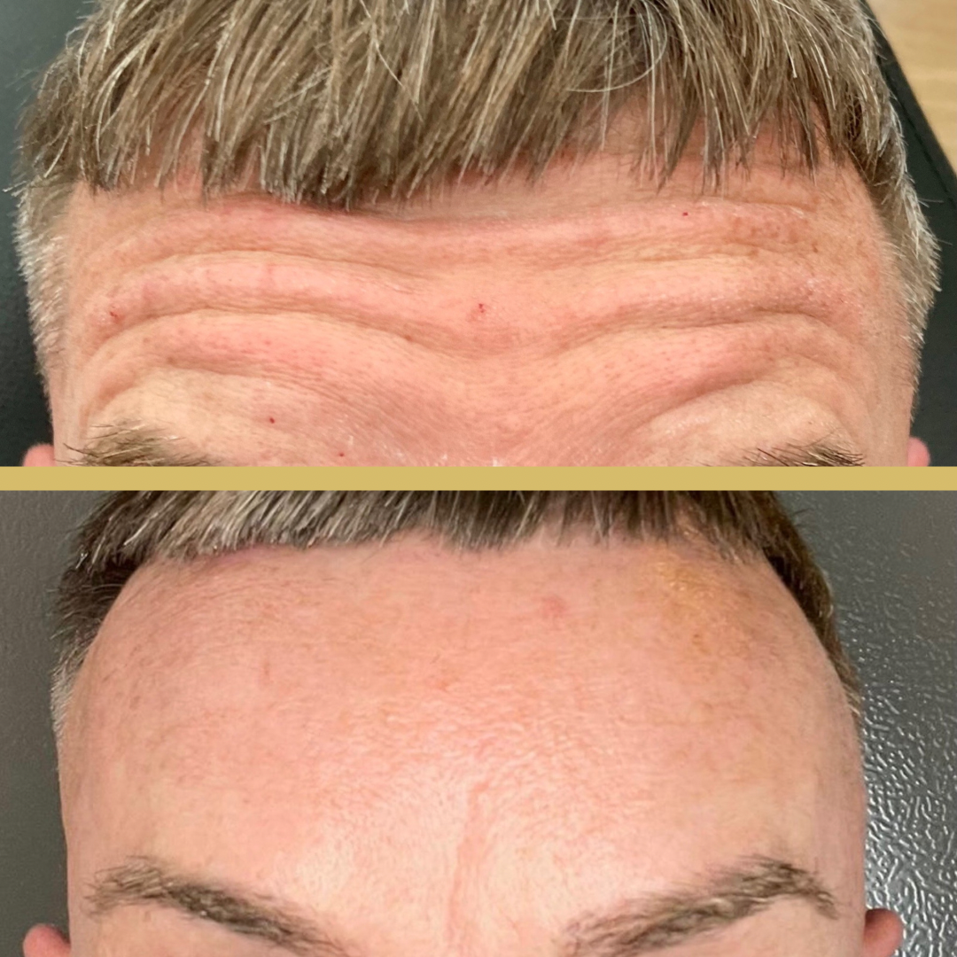 before and after botox2.PNG