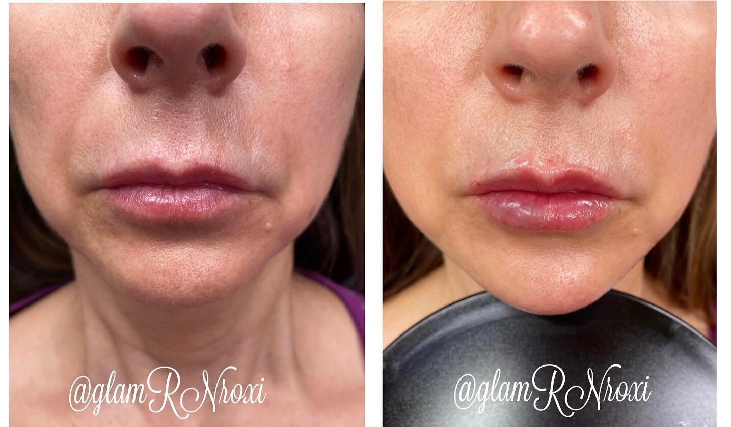 Lower facial rejuvenation for this lovely lady ❤️. Chin augmentation, prejowl sulcus filler, and lips of course ☺️💋 Yes, I realize the after picture is lighter, but it&rsquo;s hard as hell to get the exact same lighting an hour later so judge away a