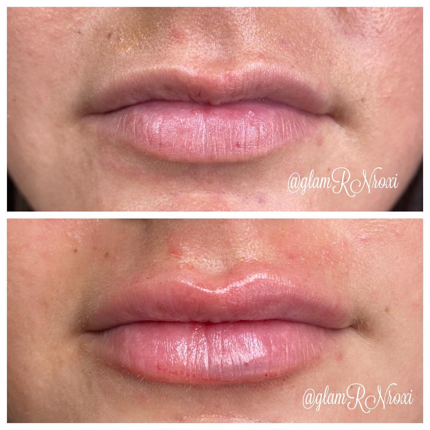 I see this shape a ALOT. It is a very difficult lip that take some serious, tedious finessing and a specific technique that I have perfected over many years of doing lips💋💅 #lips #lip #lipfiller  #lips #lipfiller #lipflip #lipinjections #lipinjecto