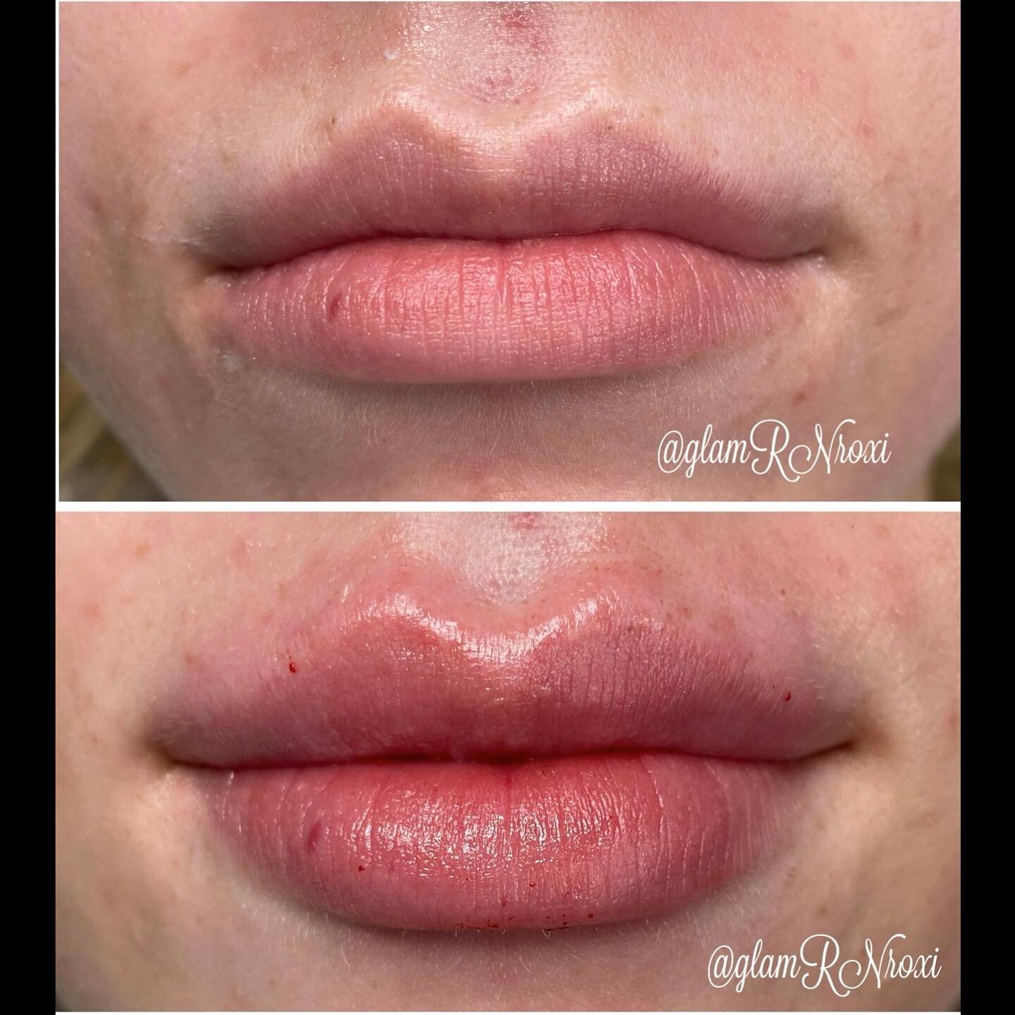 The way the shape turned out tho 💋🥰 #lips #lip #lipfiller  #lips #lipfiller #lipflip #lipinjections #lipinjectors #lipaugmentation #lipartist #liplove #lipart #pout #poutylips #lipstick
#utah #saltlakecity #transformation #beforeandafter #saltlakec
