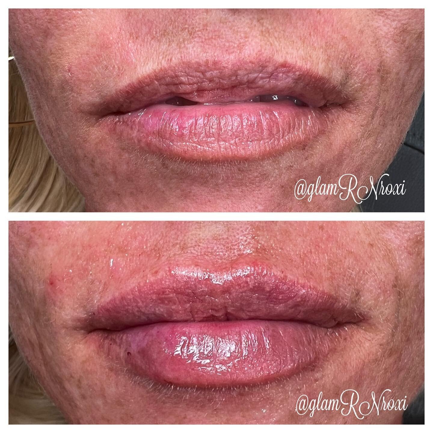 It was so fun watching these come to life like I pictured in my head 💋😍 #lips #lip #lipfiller  #lips #lipfiller #lipflip #lipinjections #lipinjectors #lipaugmentation #lipartist #liplove #lipart #pout #poutylips #lipstick
#utah #saltlakecity #trans