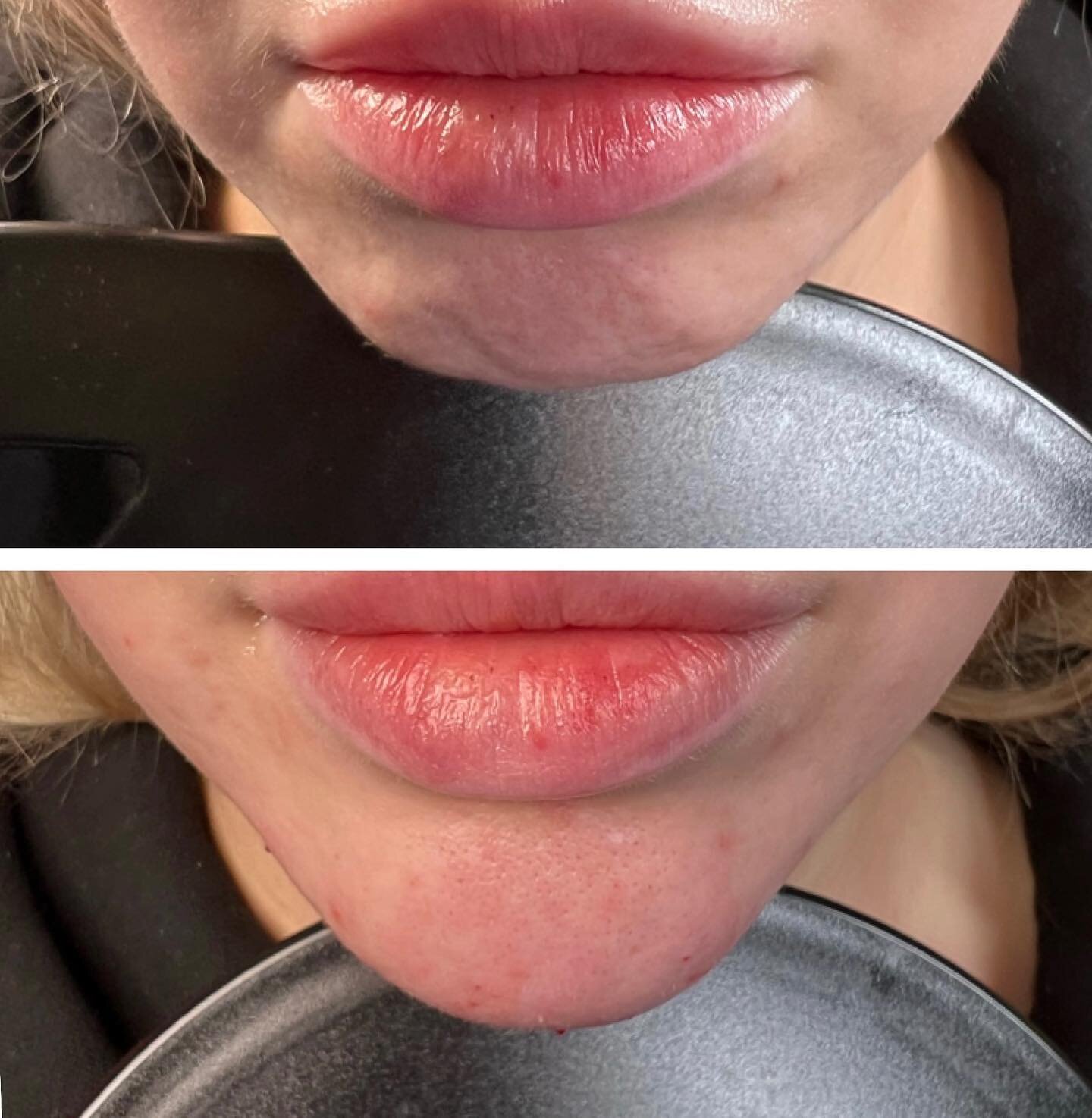 BIO FILLER has taken over Glam Lounge and I couldn&rsquo;t be happier!! Look at this BEAUTIFUL CHIN! 100% natural. 100% vegan. ALL YOU!! No synthetic materials, no migration, no lumps, bumps or risk of disproportionate angles. It interfaces seamlessl
