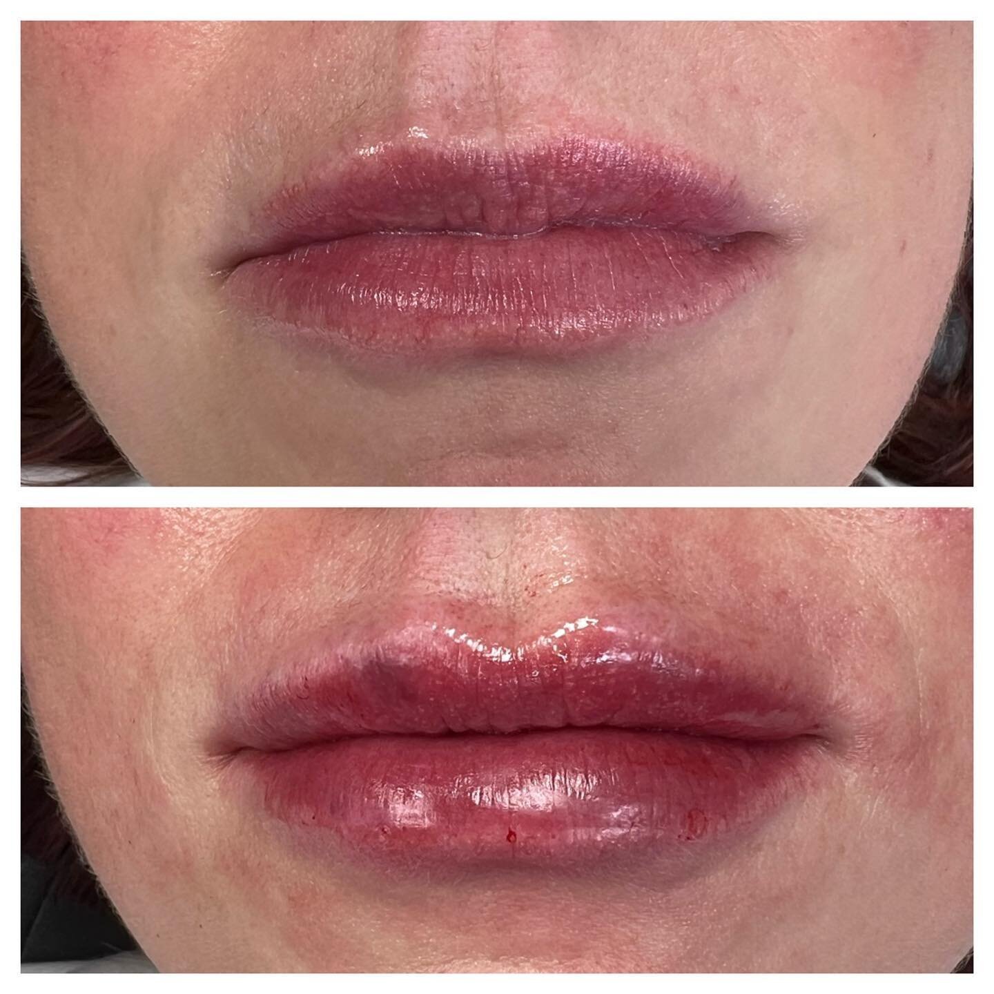 &ldquo;Roxi, I really want a defined border.&rdquo; Well, here you go sister 😊💋💋💋 #lips #lip #lipfiller  #lips #lipfiller #lipflip #lipinjections #lipinjectors #lipaugmentation #lipartist #liplove #lipart #pout #poutylips #lipstick
#utah #saltlak