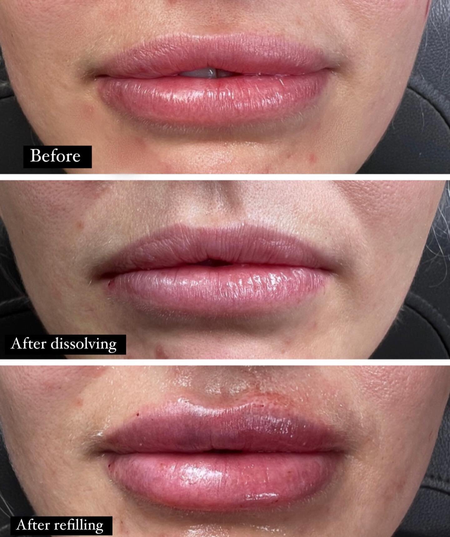 I haven&rsquo;t posted a revision in a minute but let&rsquo;s talk about these 🗣️. The way lips are injected can affect the harmony and balance of the face in so many ways!  For example, in the top photo you can see the way these lips were injected 