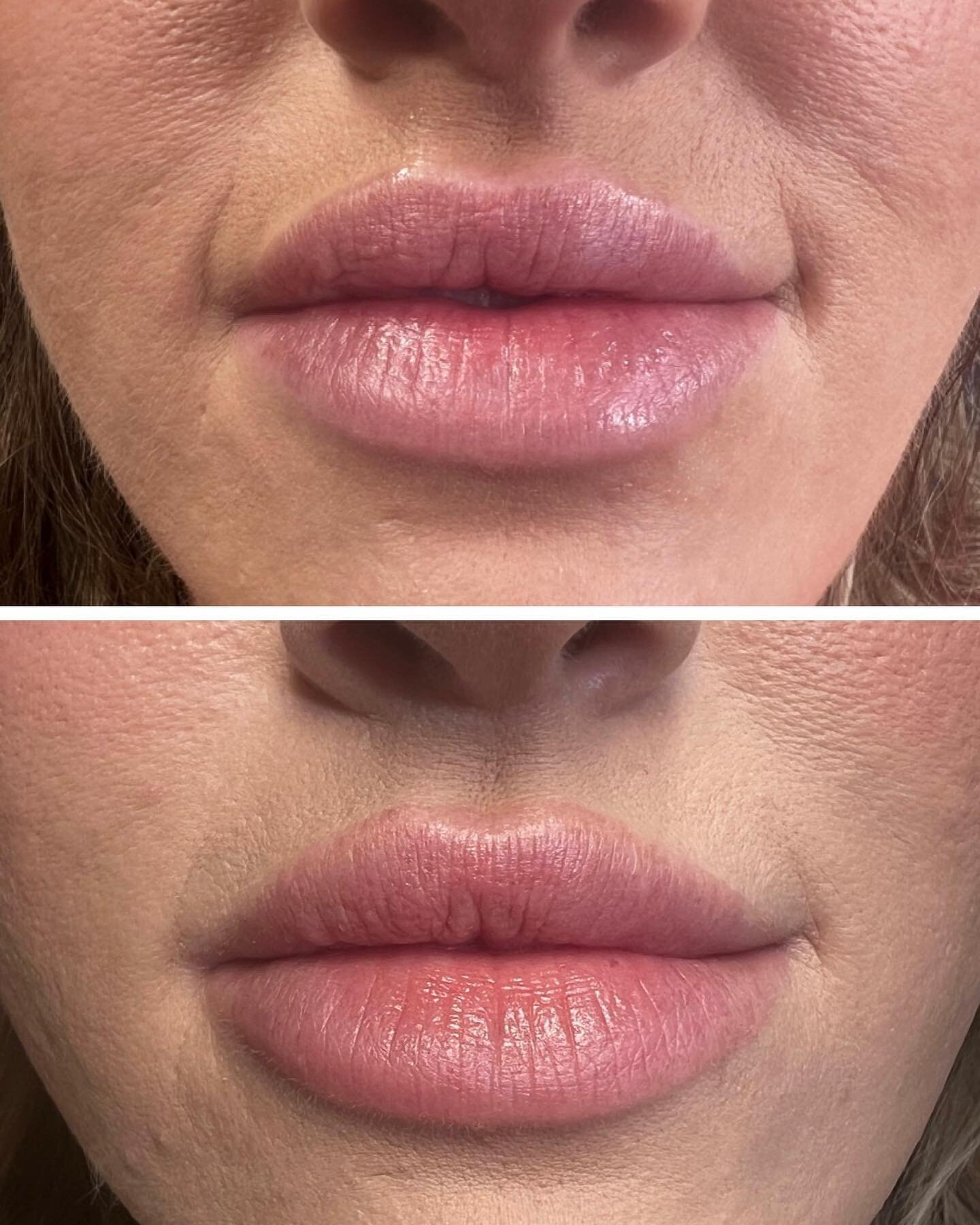 💋I love a good lip revision! Especially an after picture when they are completely healed! 💉 The bottom pic was taken 3 weeks after we refilled them (we dissolved first of course!) ☺️&hearts;️ look how much SOFTER those edges look 😍😍#lips #lip #li