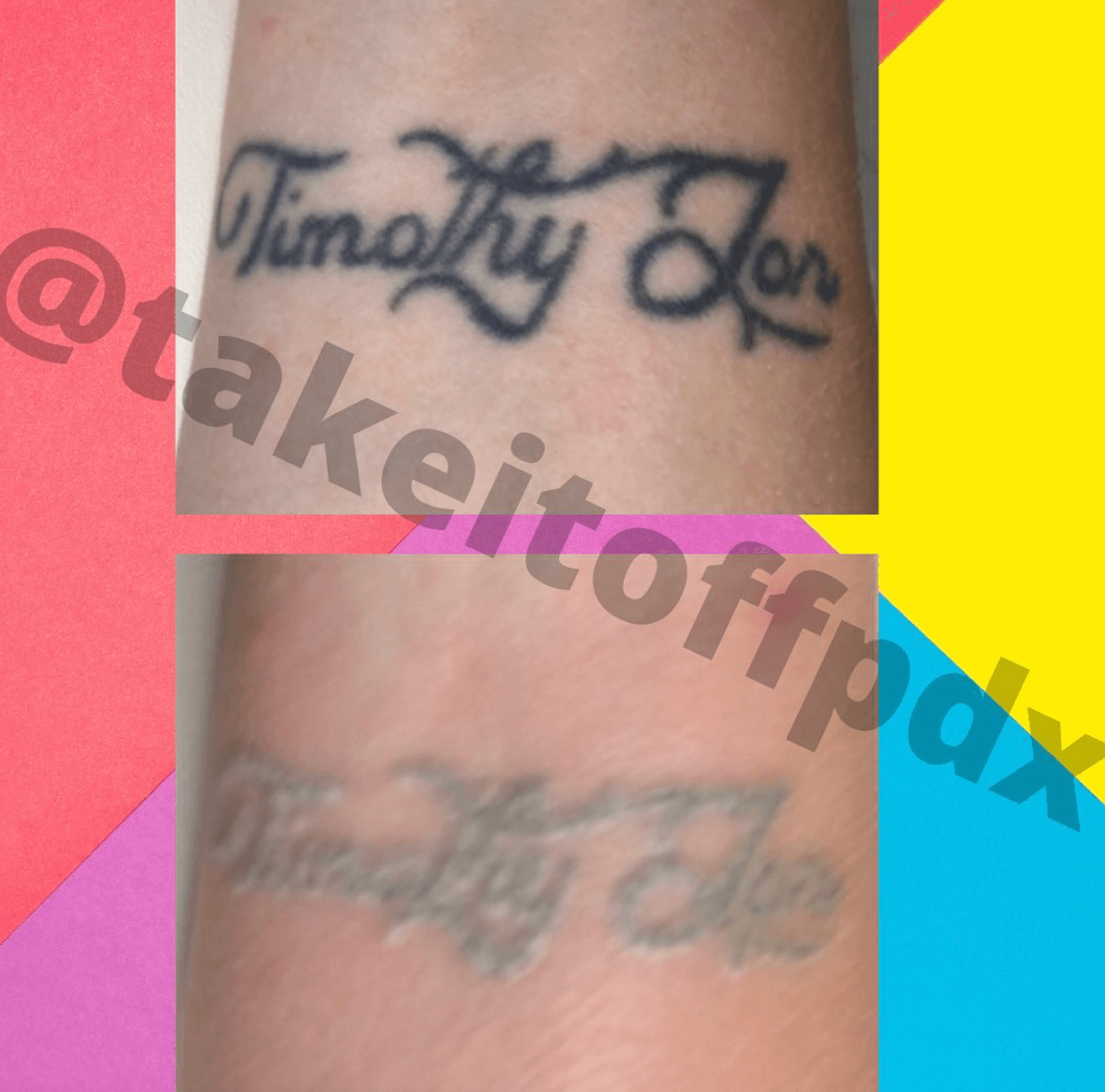 Details more than 63 tattoo removal portland oregon in.cdgdbentre