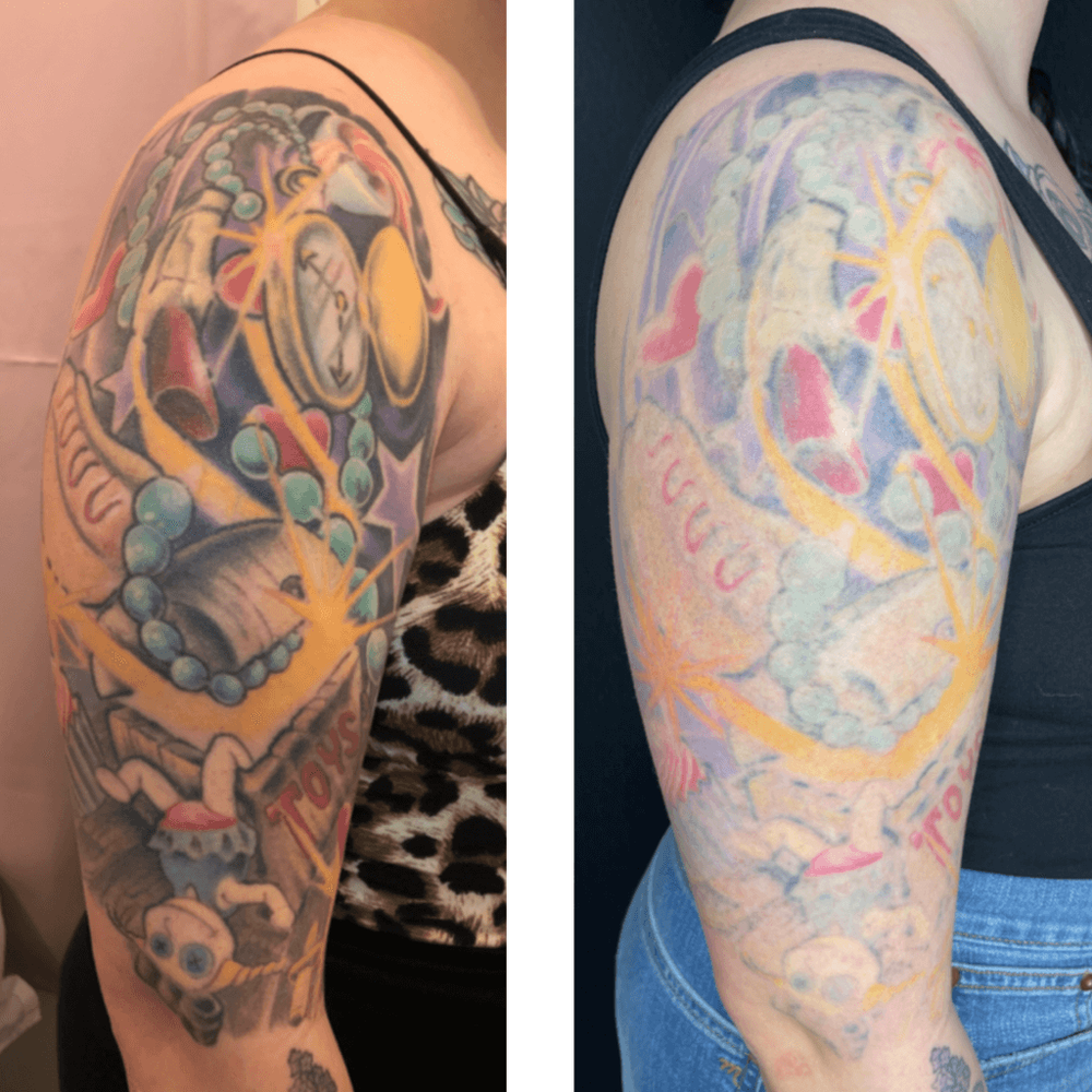 Laser Tattoo Removal at Take It Off — Pink Panther Tattoo PDX