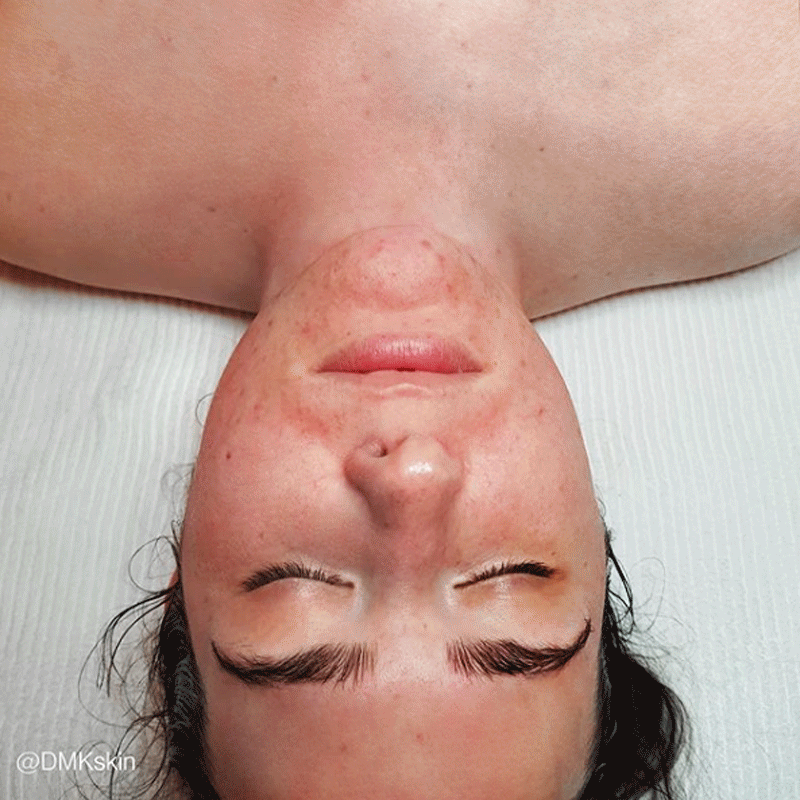 A woman lying on her back with her eyes closed, showing her face and upper chest, with visible skin plasma effect after the DMK enzyme facial treatment.
