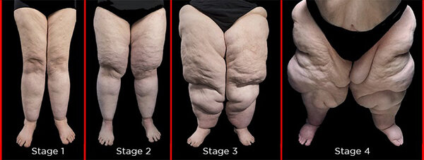 What You Need to Know About Lipedema - OncoPelvic PT