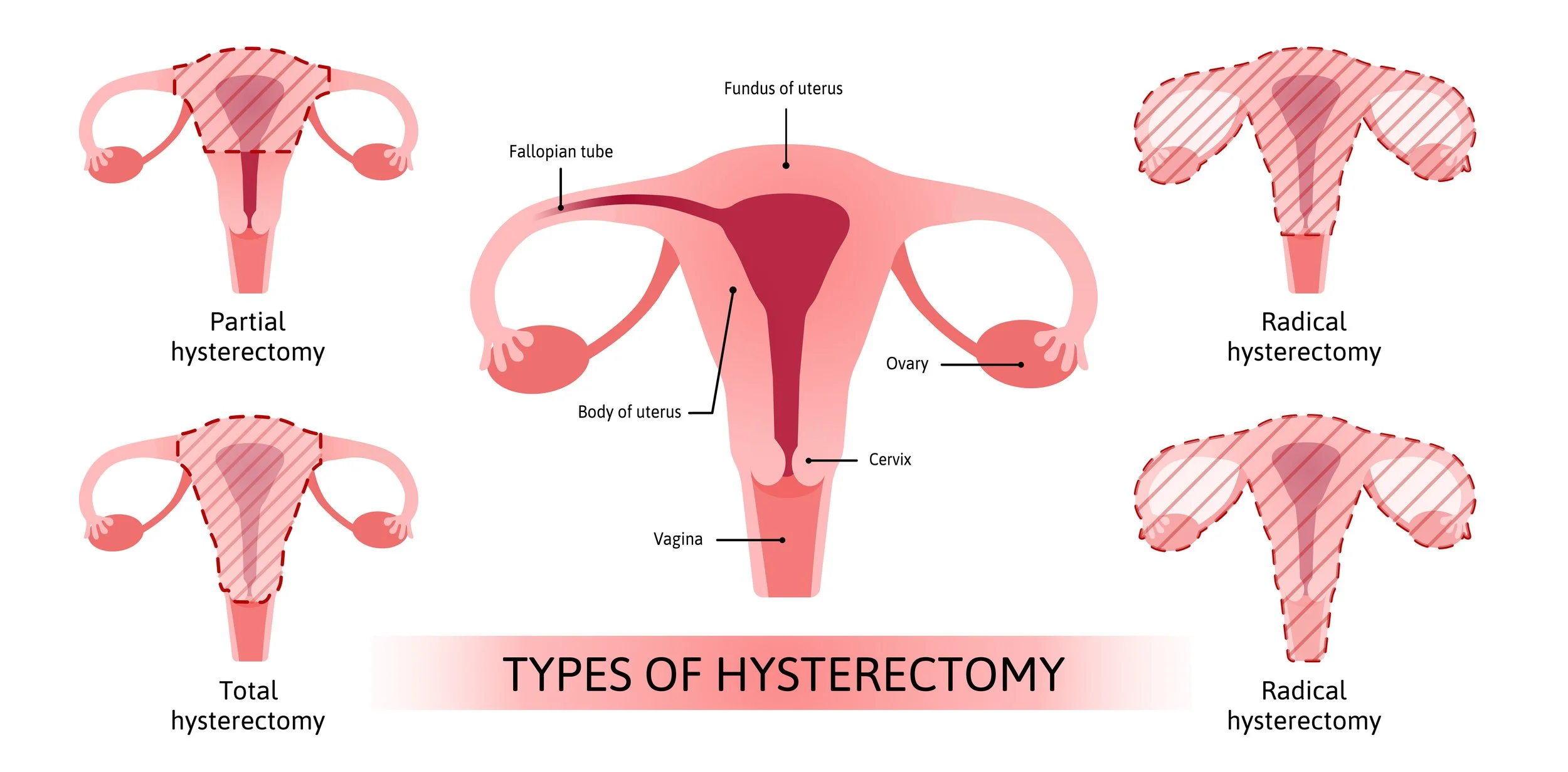 types of hysterectomy