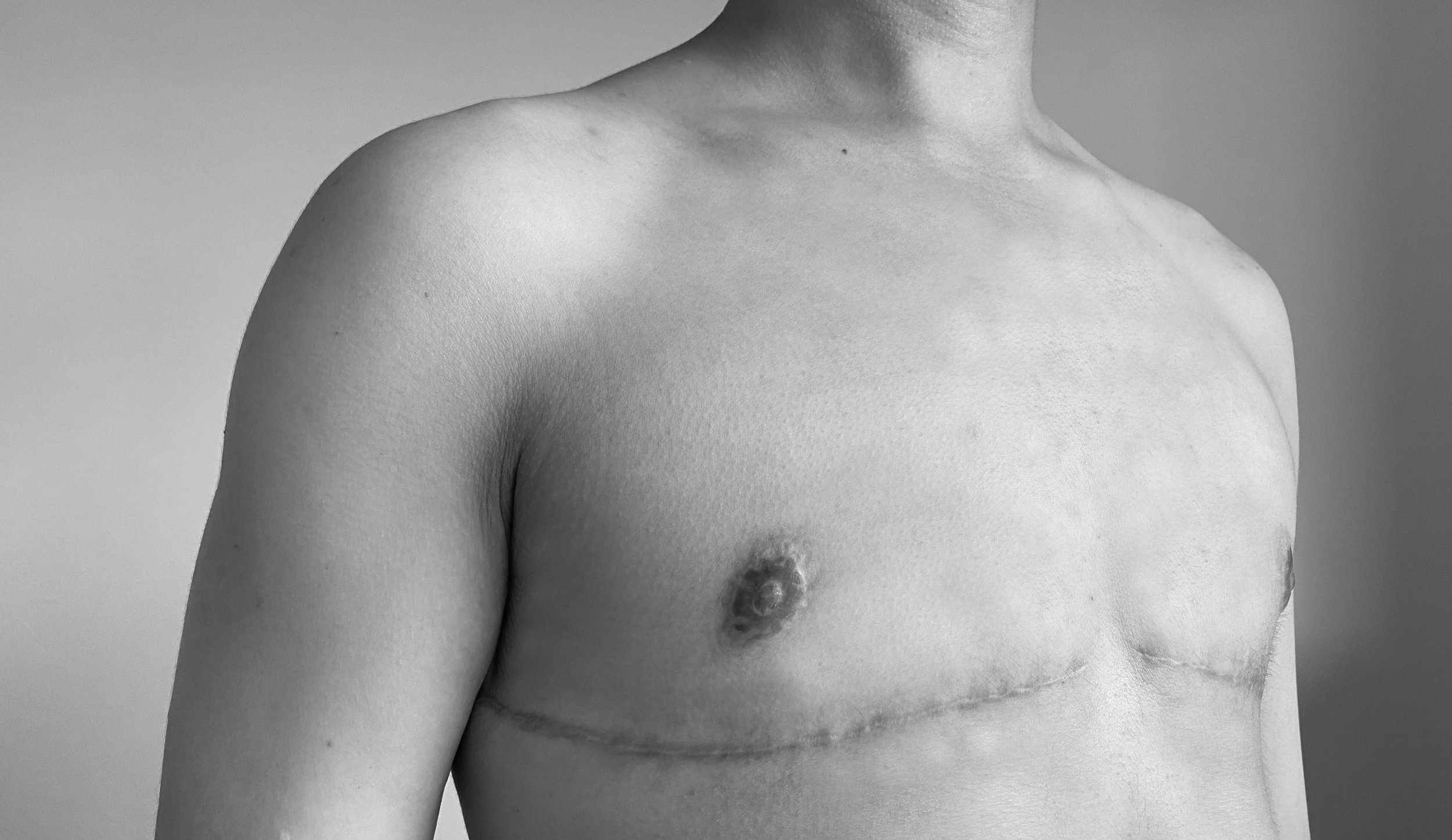 Trans man post-top surgery