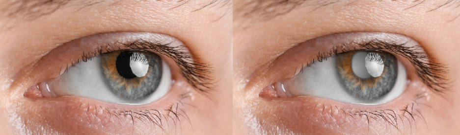 early signs of glaucoma