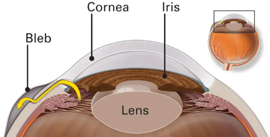 Glaucoma Woo University free CE protecting vision learning about glaucoma what is glaucoma