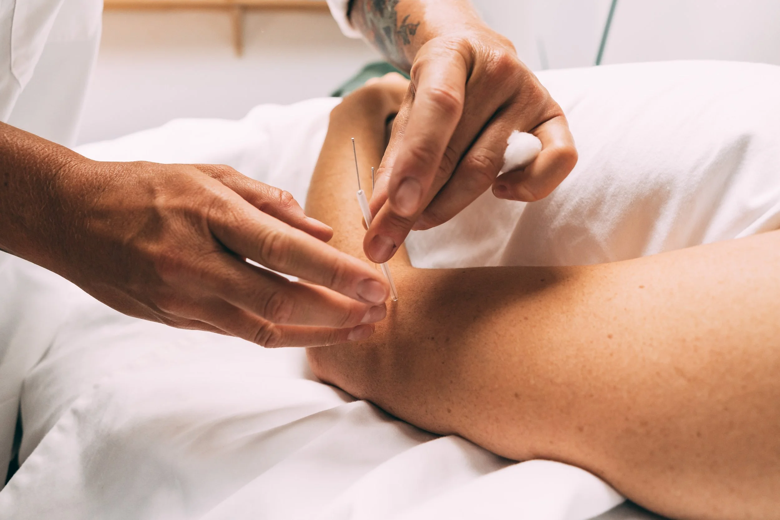 L’Acupuncture à la rescousse des douleurs du coude 