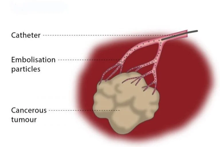 Step 1 : Starve the tumor by cutting off the blood supply