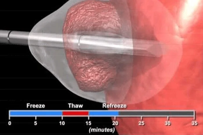 Step 2 : Use extreme cold to freeze cancerous tissue
